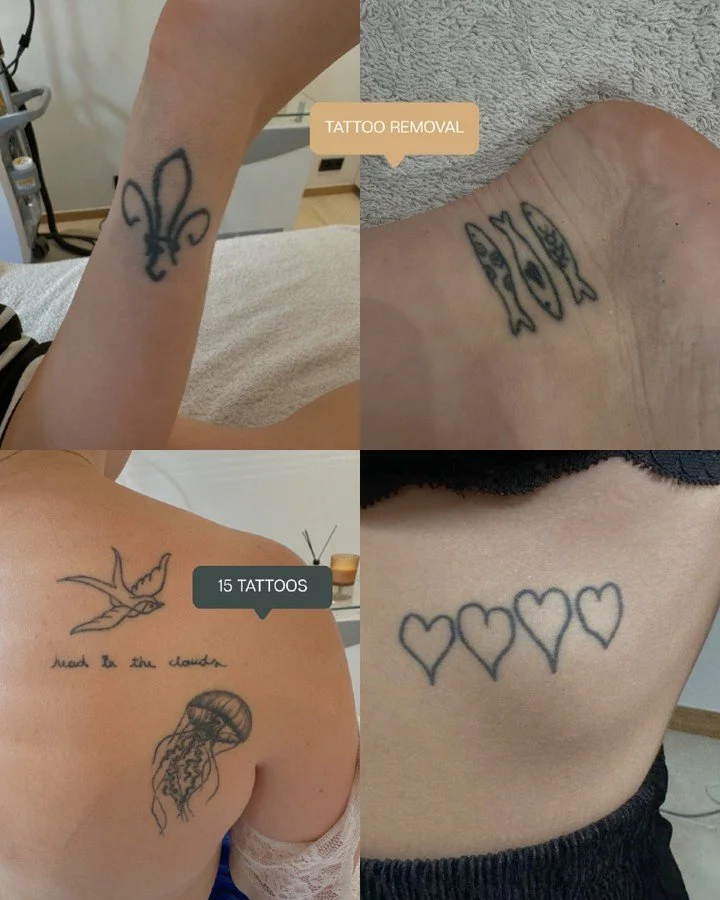15 tatoeages in &eacute;&eacute;n keer laten verwijderen. Dat is er eentje waarvan wij ook even dachten: wow.

Want het is geen geheim dat tattoo removal geen aangename behandeling is. Het kan best intens zijn, dus dat iemand dit voor 15 tattoos tege