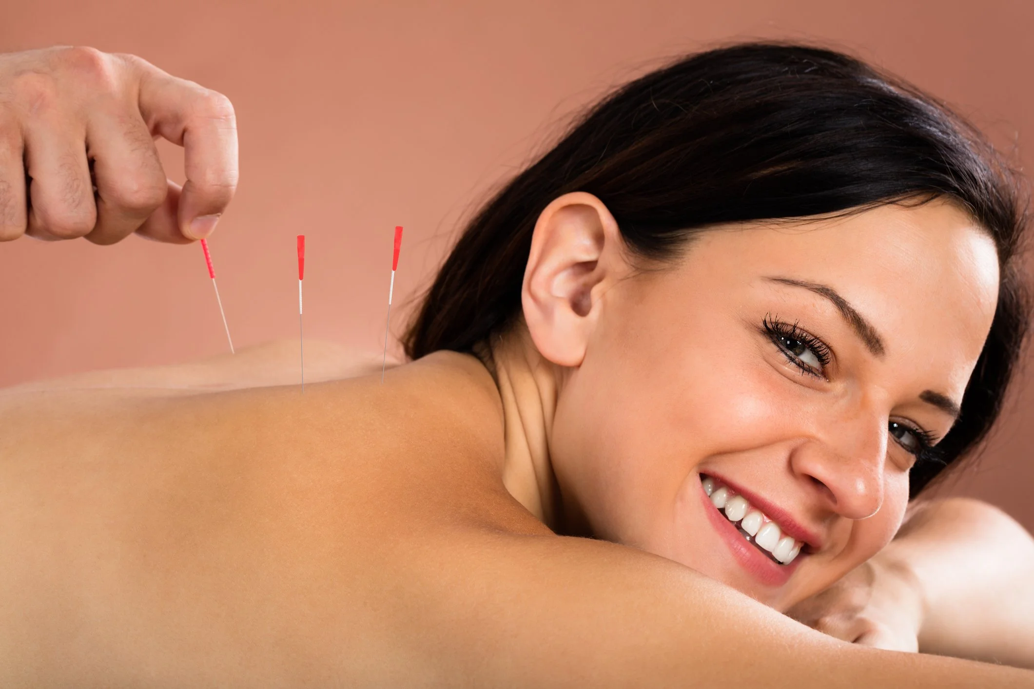 A smiling woman with dark hair is receiving acupuncture treatment on her upper back with thin acupuncture needles inserted into her skin.