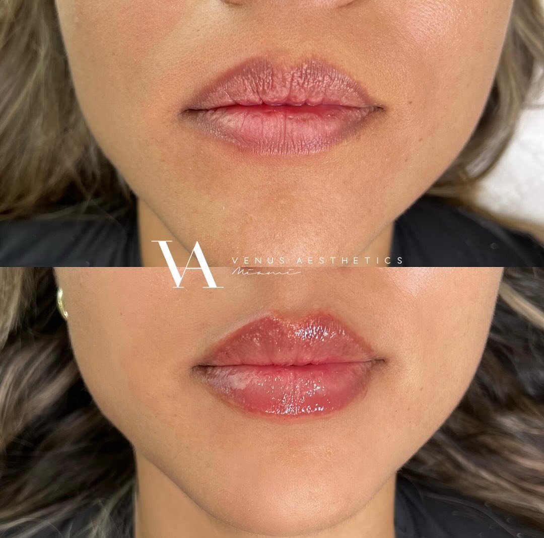 our NATURAL signature lips never fail ✨
1 ML plump to hydrate these first time lips 
&bull;
&bull;
&bull;
&bull;
&bull;
&bull;
&bull;
&bull;
&bull;
BOOK NOW⬇️
📞 (786)427-9877 call/text
💭DM us on IG
🗓️visit the booking link in our bio 📧info@venusa