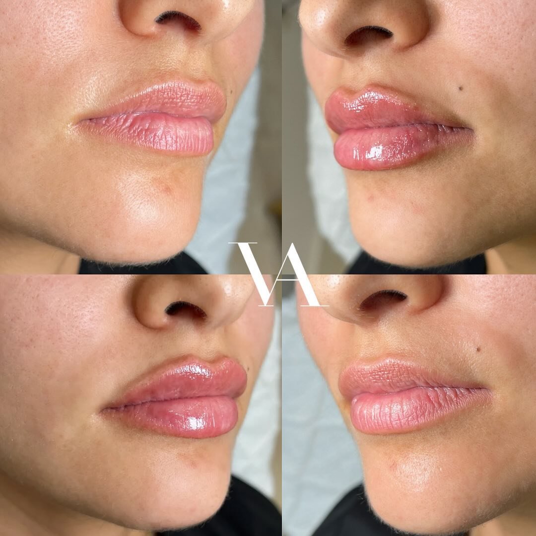our signature lip- a natural, yet noticeable result 💉✨
&bull;
&bull;
&bull;
&bull;
&bull;
&bull;
&bull;
&bull;
&bull;
BOOK NOW⬇️
📞 (786)427-9877 call/text
💭DM us on IG
🗓️visit the booking link in our bio 📧info@venusaestheticsmiami.com

#filler #