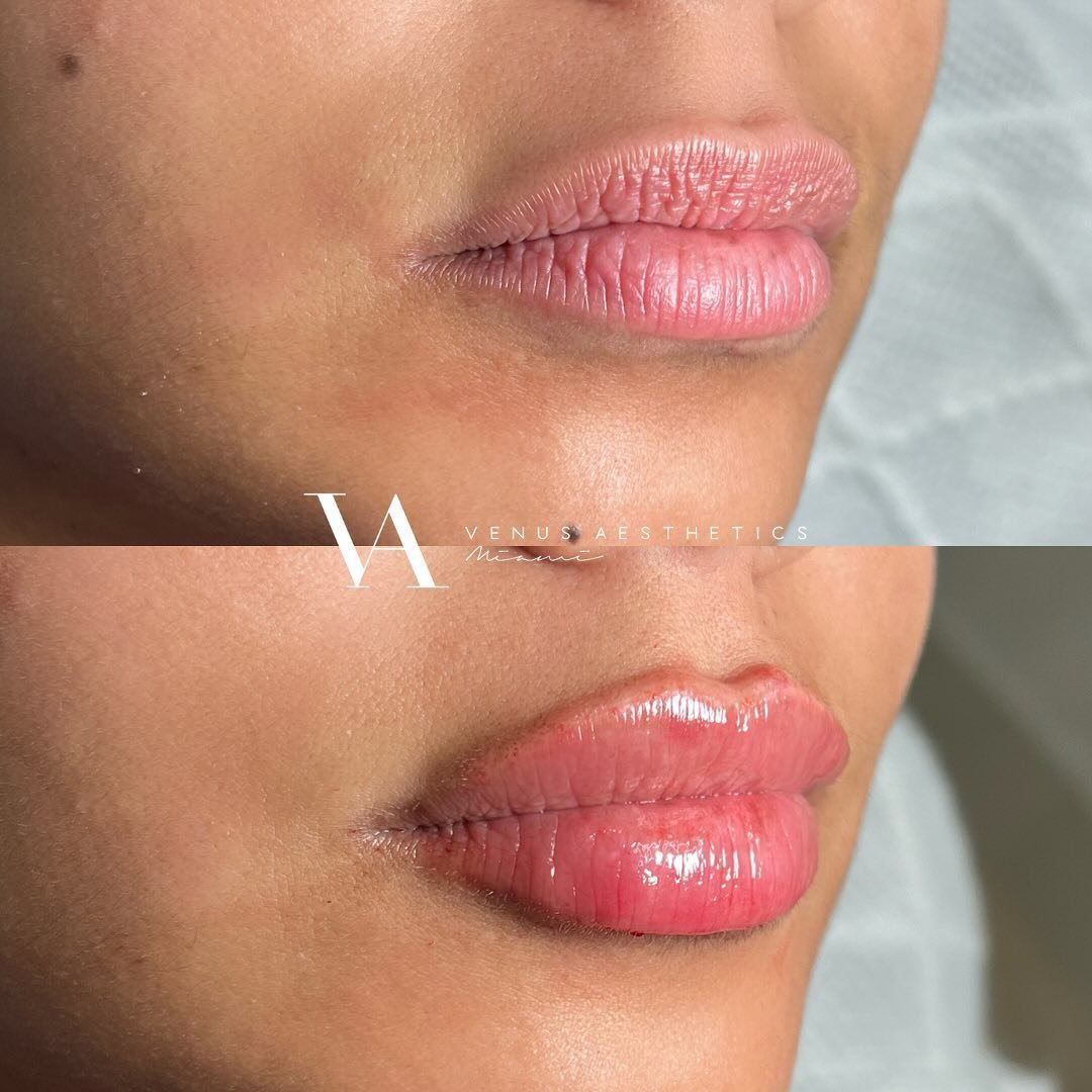 this transformation is EVERYTHING 💫
-signature lip fill 
&bull;
&bull;
&bull;
&bull;
&bull;
&bull;
&bull;
&bull;
&bull;
BOOK NOW⬇️
📞 (786)427-9877 call/text
💭DM us on IG
🗓️visit the booking link in our bio 📧info@venusaestheticsmiami.com

#filler