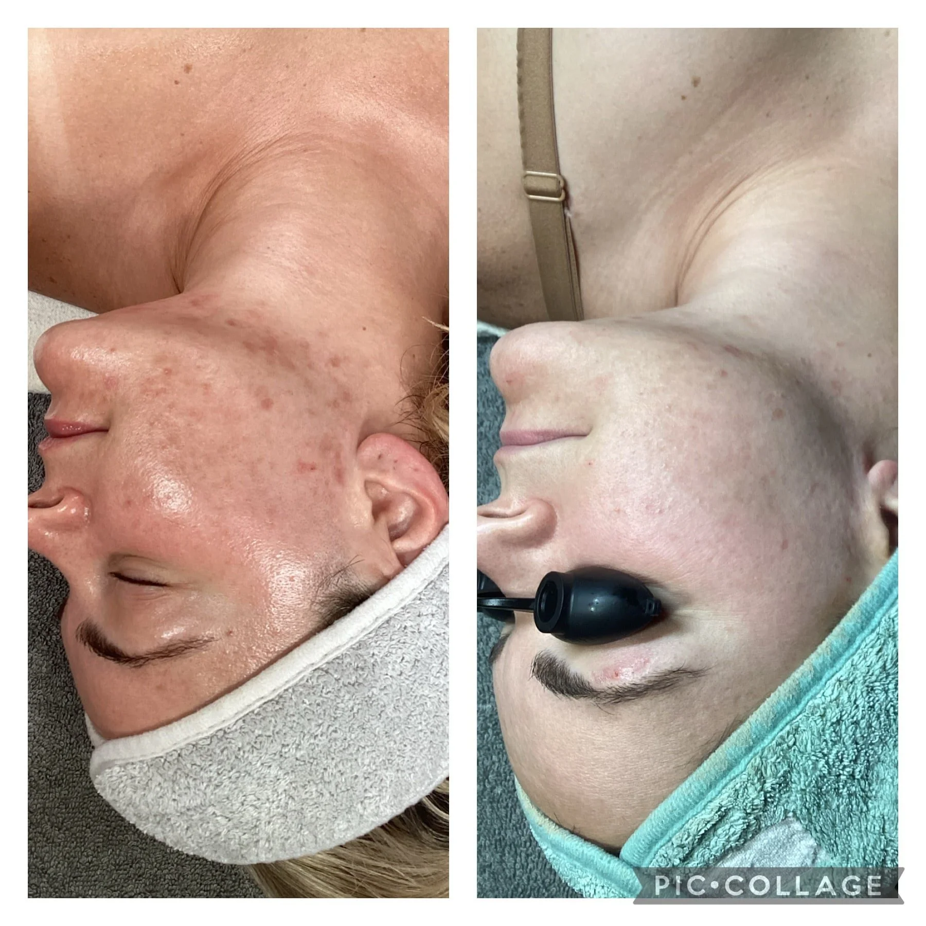 AEE Acne Client Results - Before and After 2.jpeg