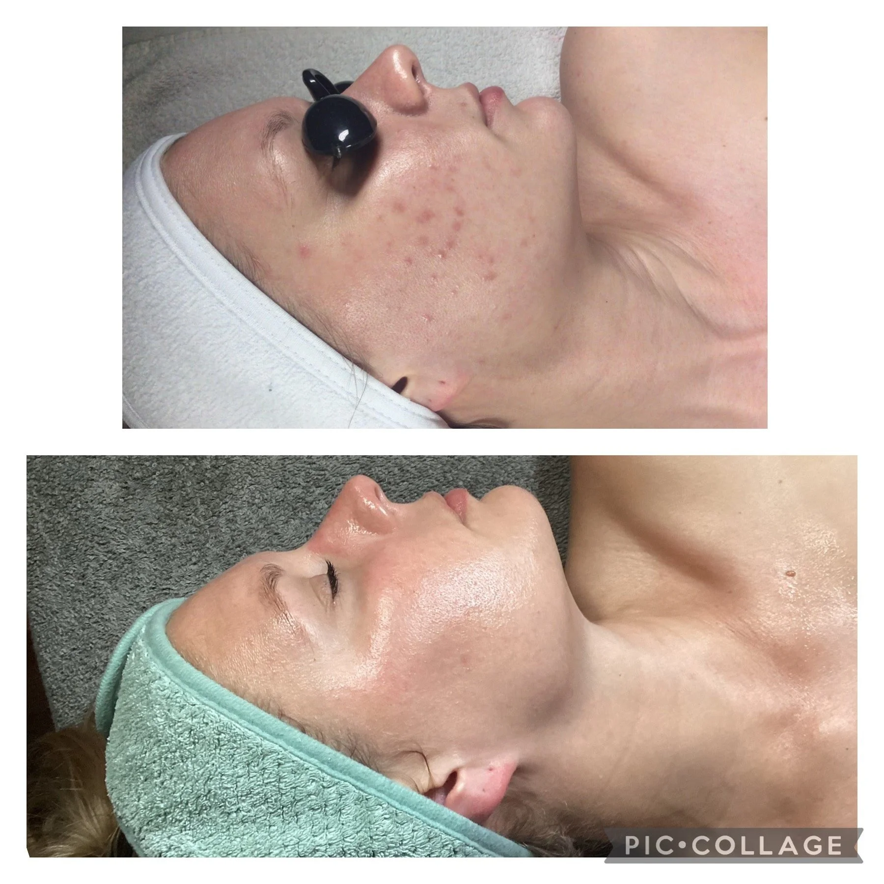 AEE Acne Client Results - Before and After 6.jpeg