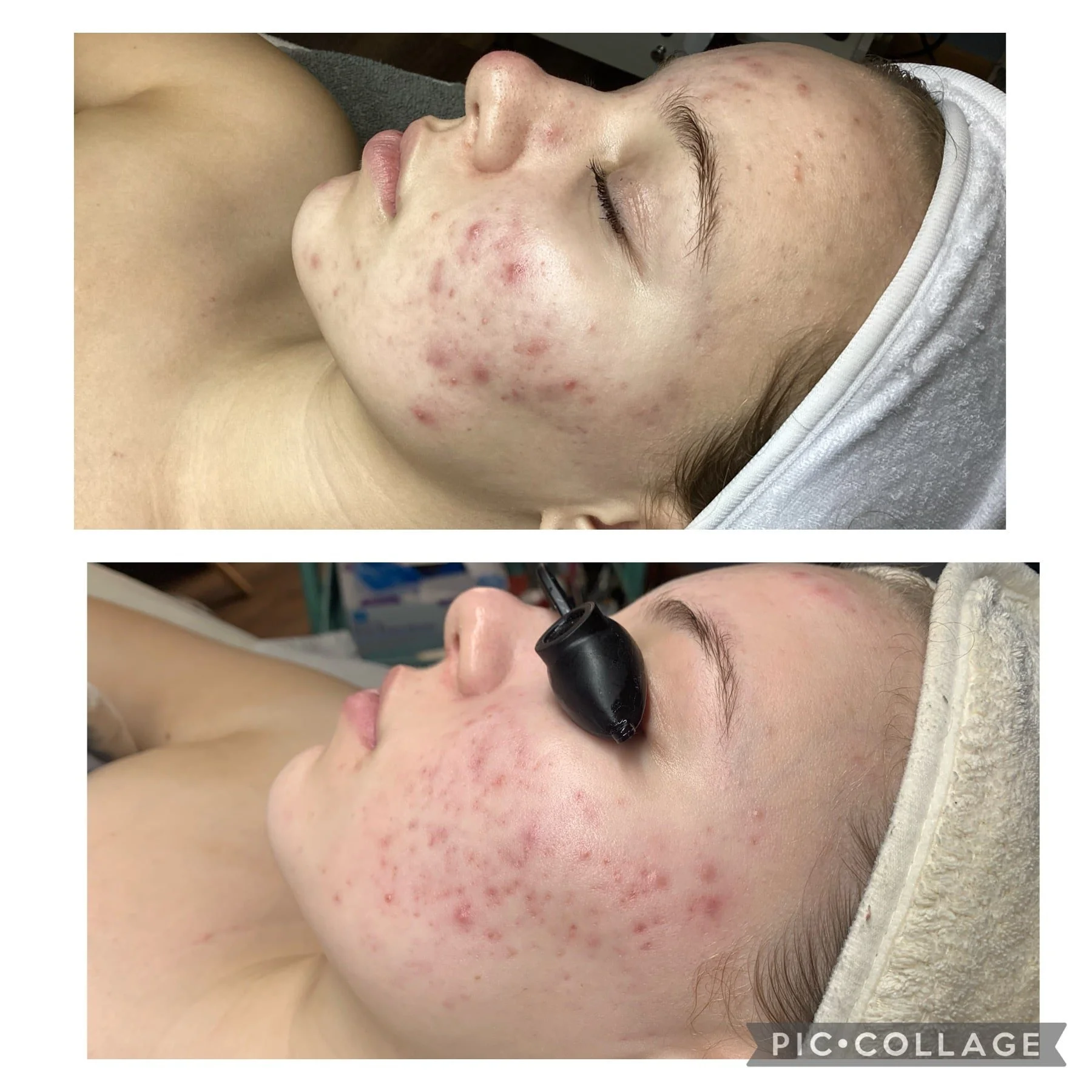 AEE Acne Client Results - Before and After 5.jpeg
