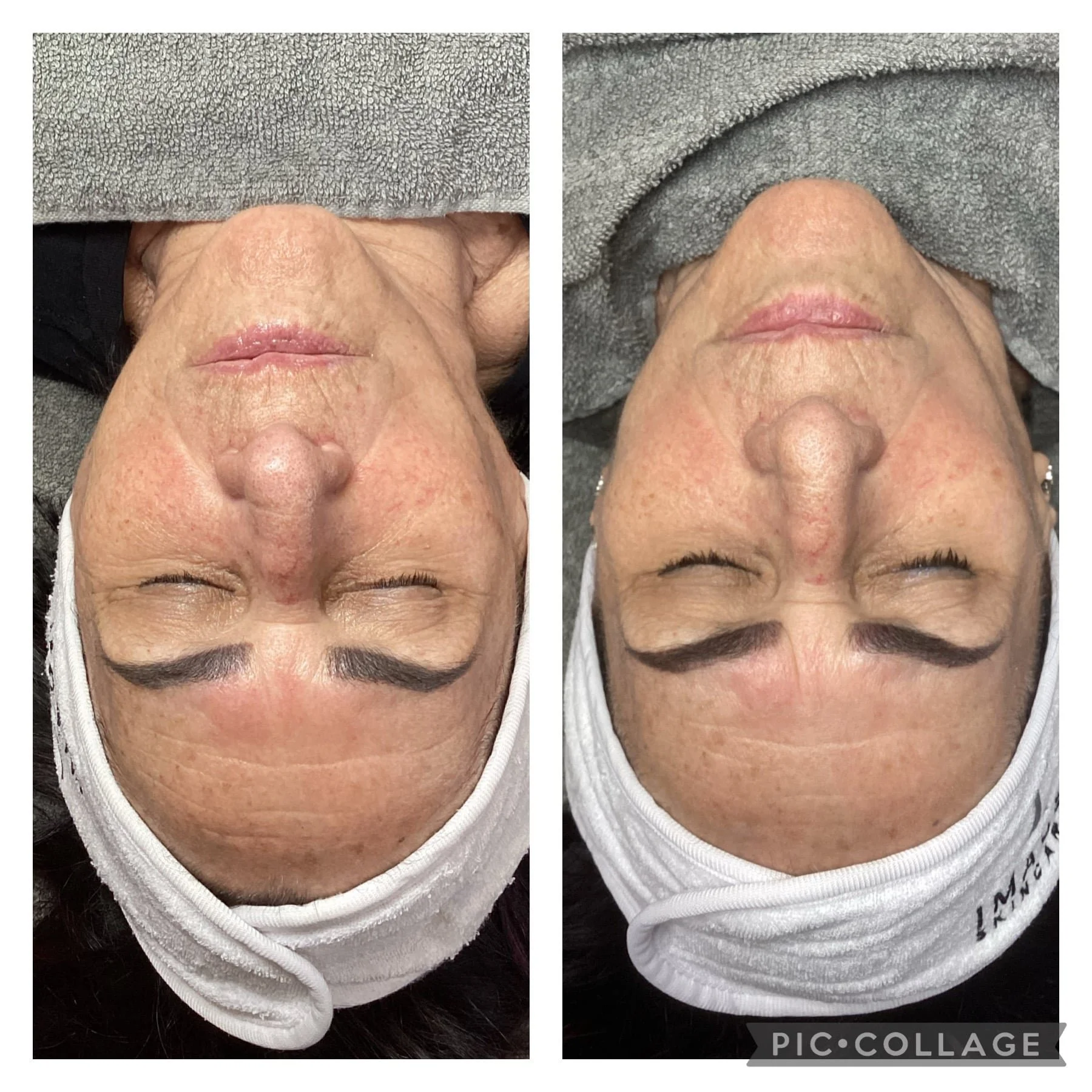 Before and After Get Glowing Peel 10.jpeg