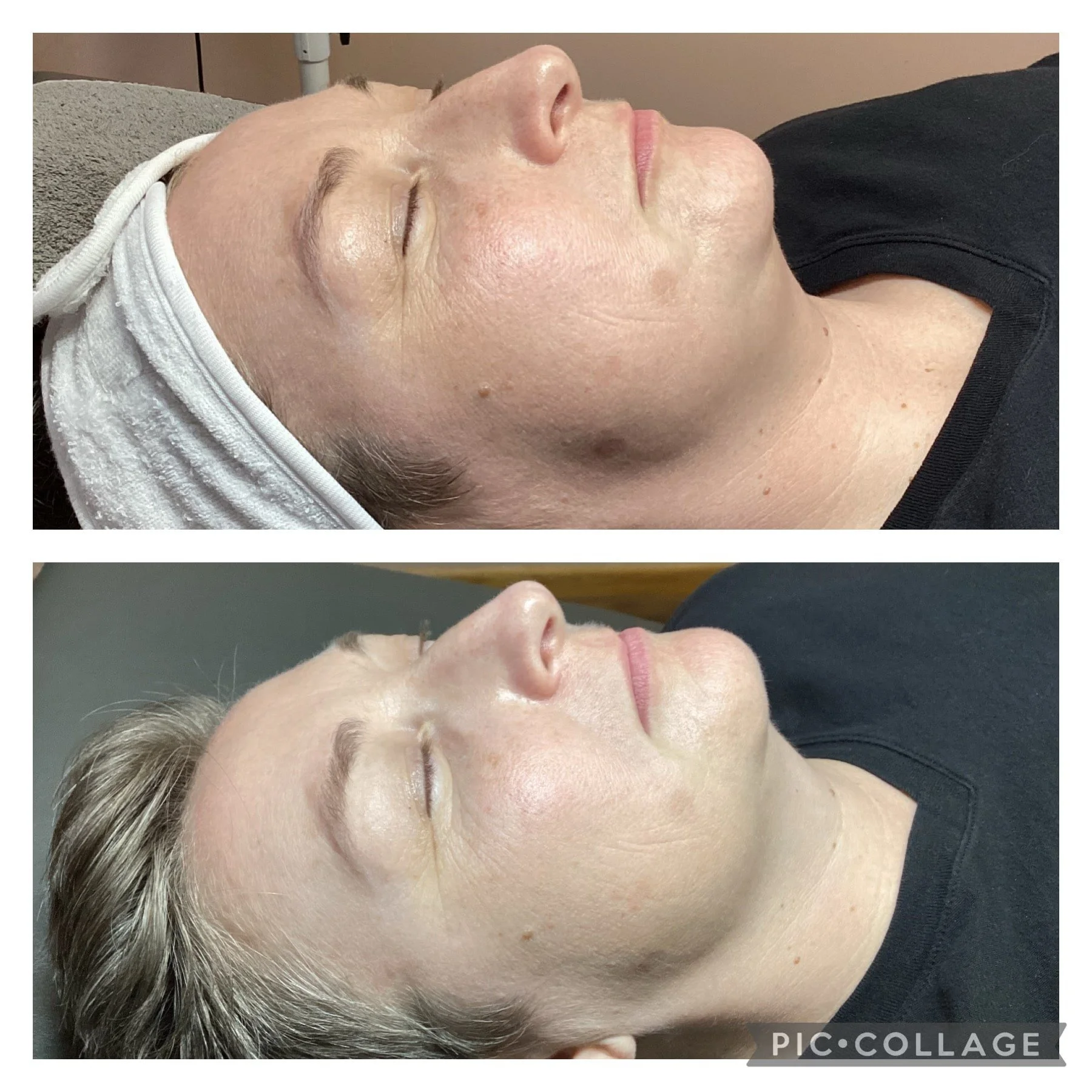 Before and After Get Glowing Peel 1.jpeg
