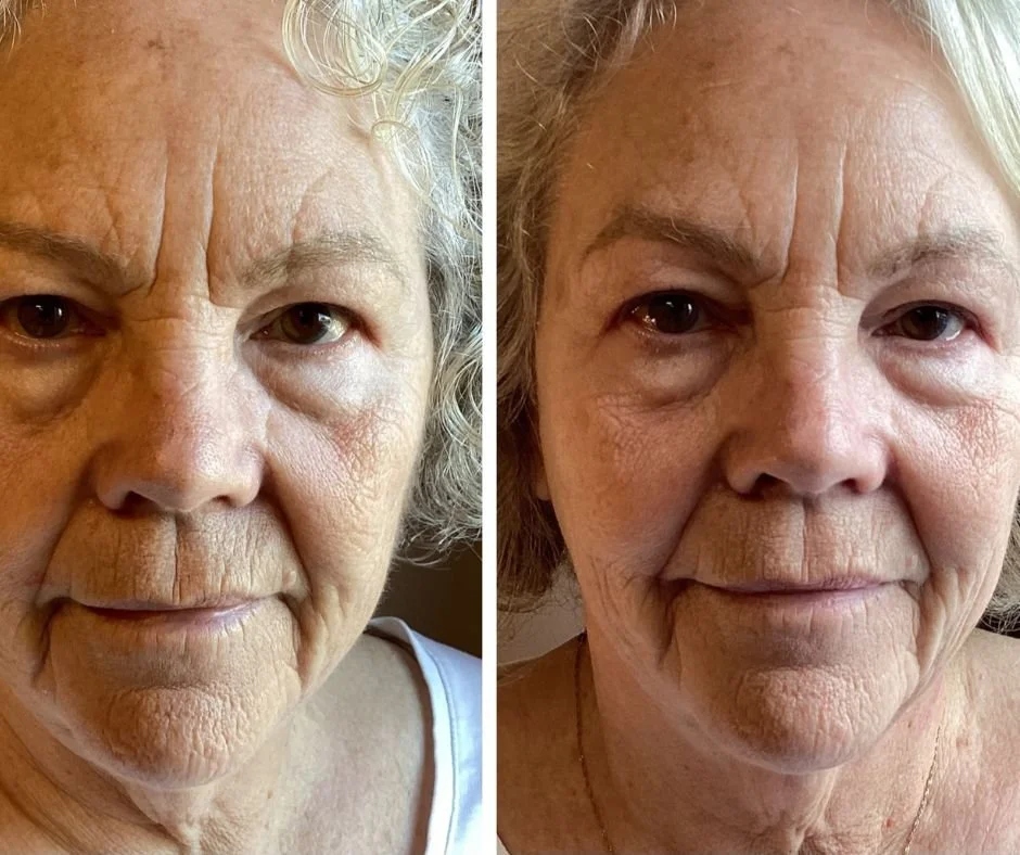 Full face results of a female before and after Jet Plasma treatments