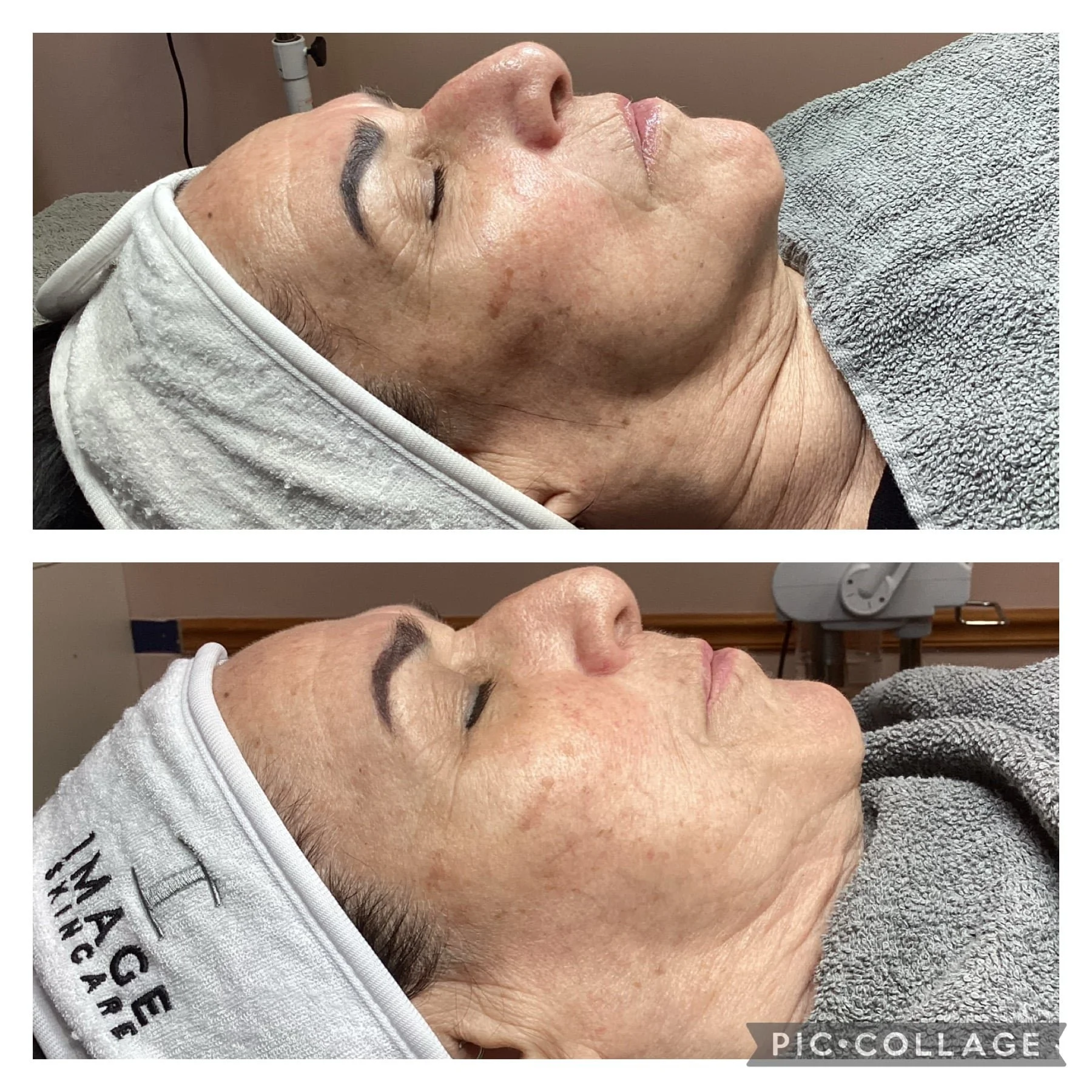 Before and After Get Glowing Peel 3.jpeg