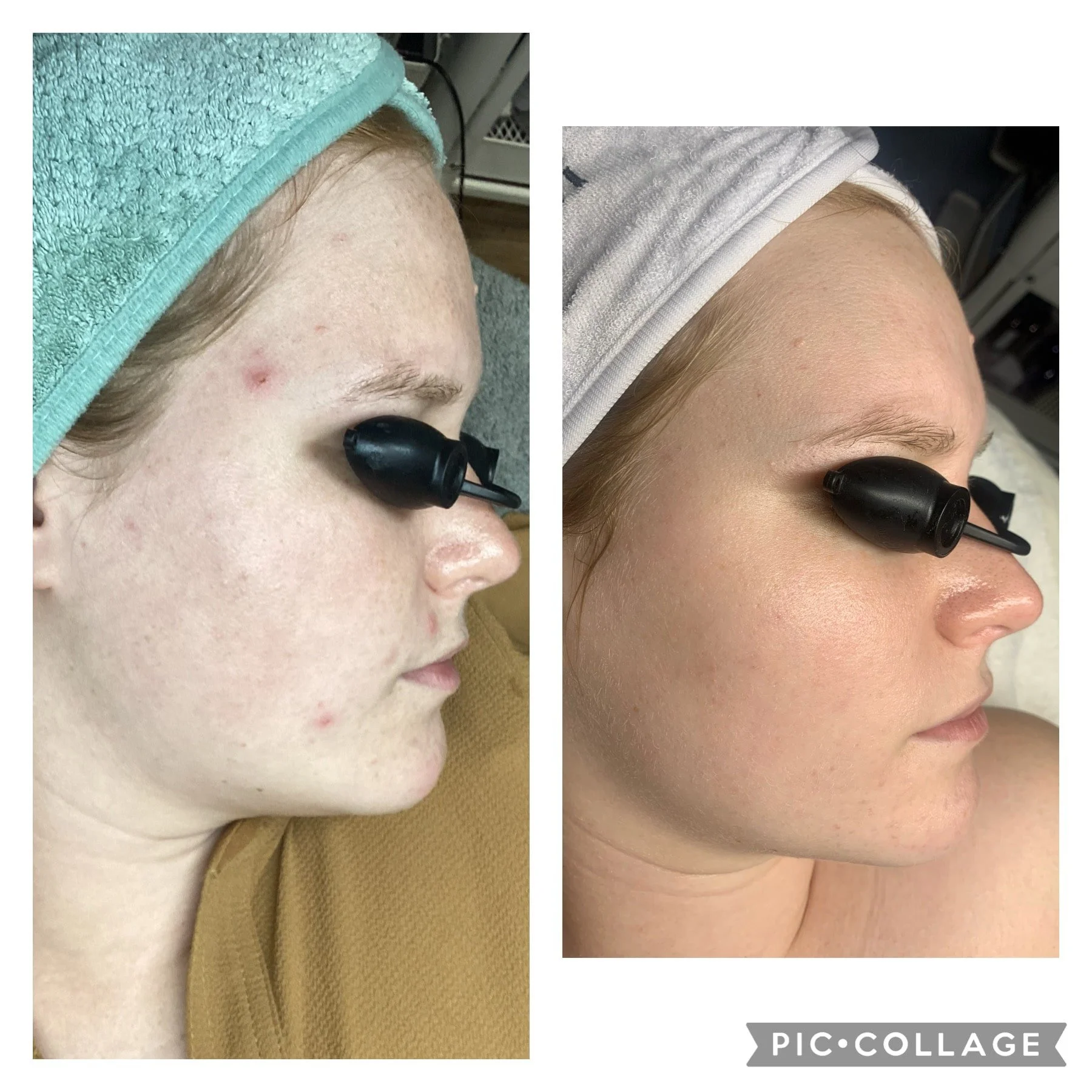 AEE Acne Client Results - Before and After 8.jpeg