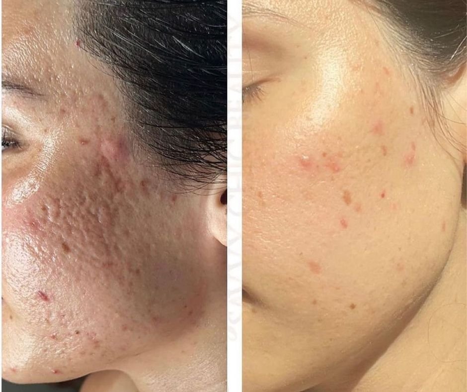 Comparison of a person's cheek before and after skin treatment, showing reduced acne scars and inflammation from Jet Plasma treatments. 