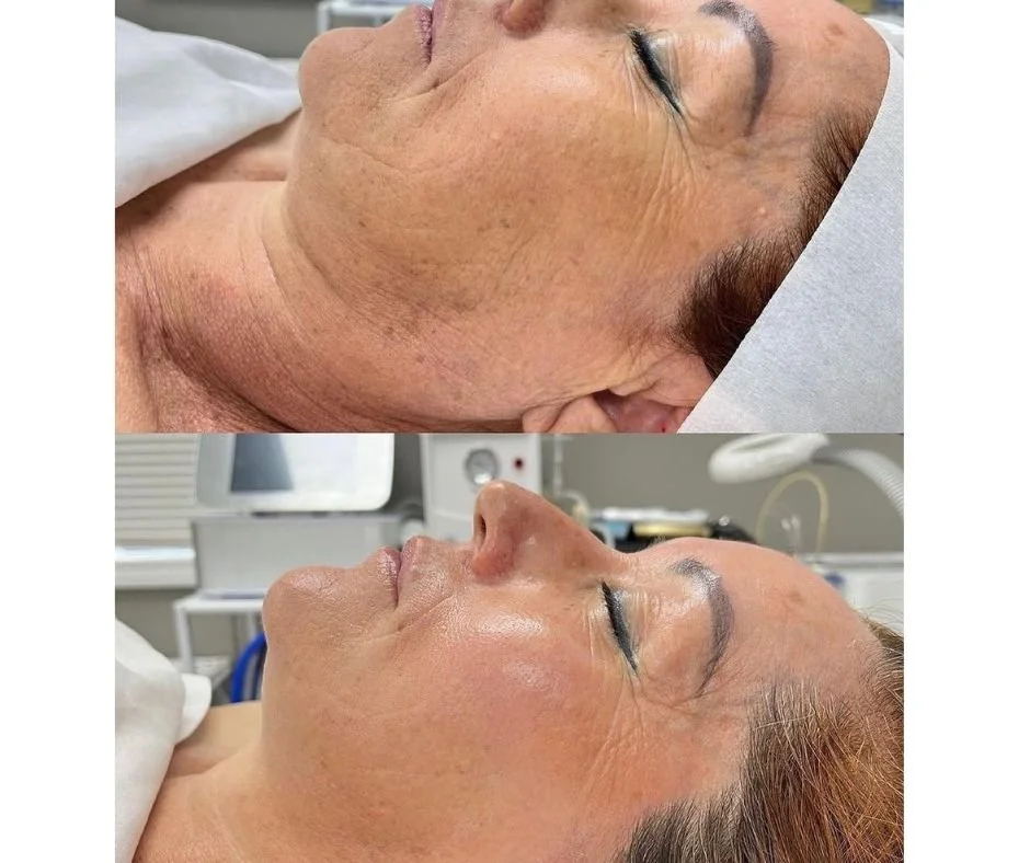 Before and after images of a woman's face showing skin improvement post facial treatment in a clinical setting.