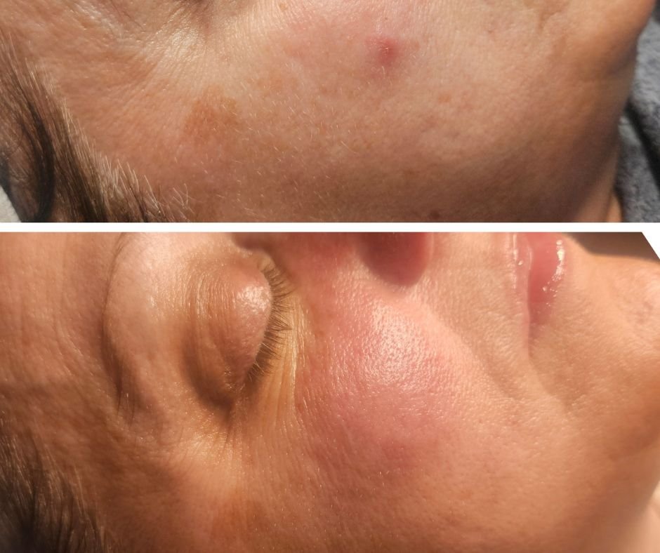 Side profile results of a female after a Jet Plasma treatment