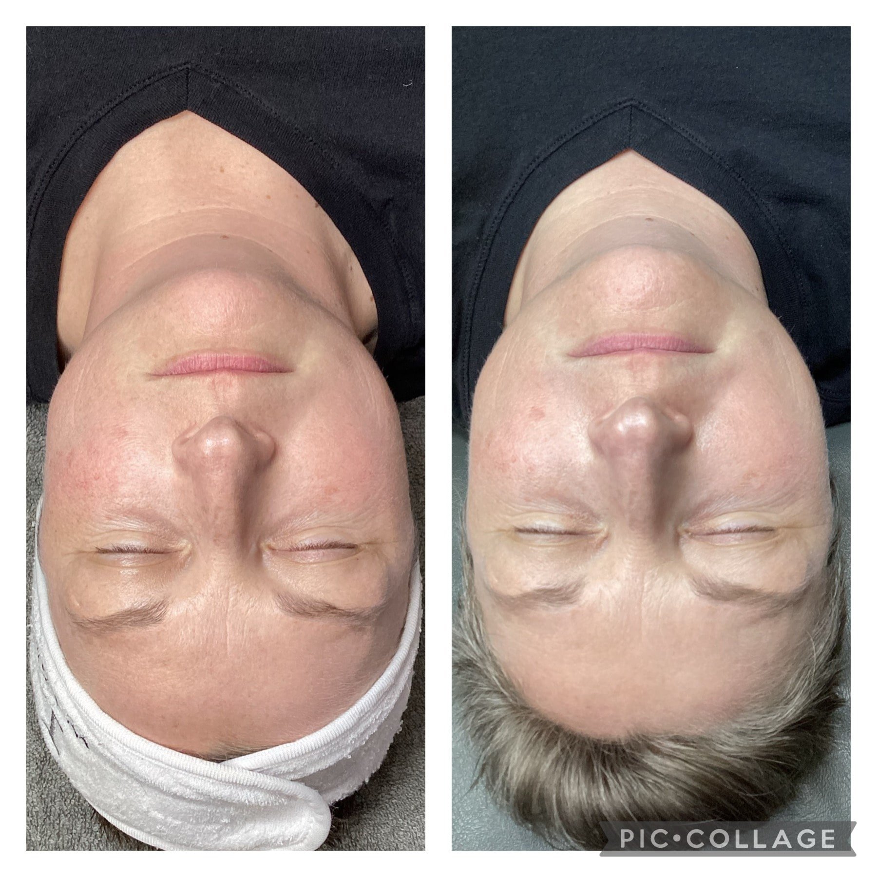Before and After Get Glowing Peel 7.jpeg