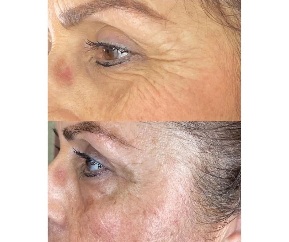 Close-up of a woman's eye area showing skin before and after treatment. The top image shows more wrinkles and age spots, while the bottom image shows smoother skin with fewer wrinkles.