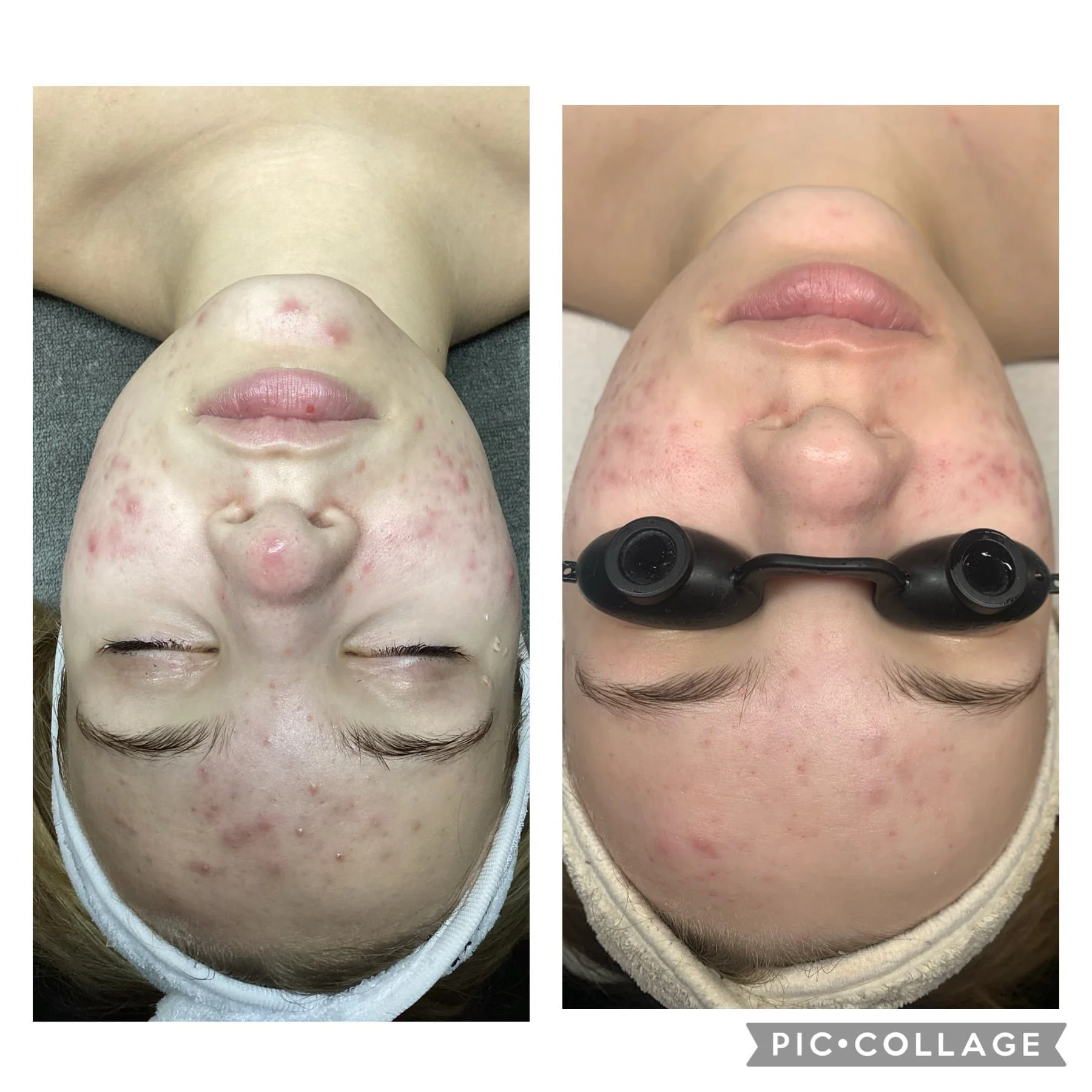 AEE Acne Client Results - Before and After 1.jpeg