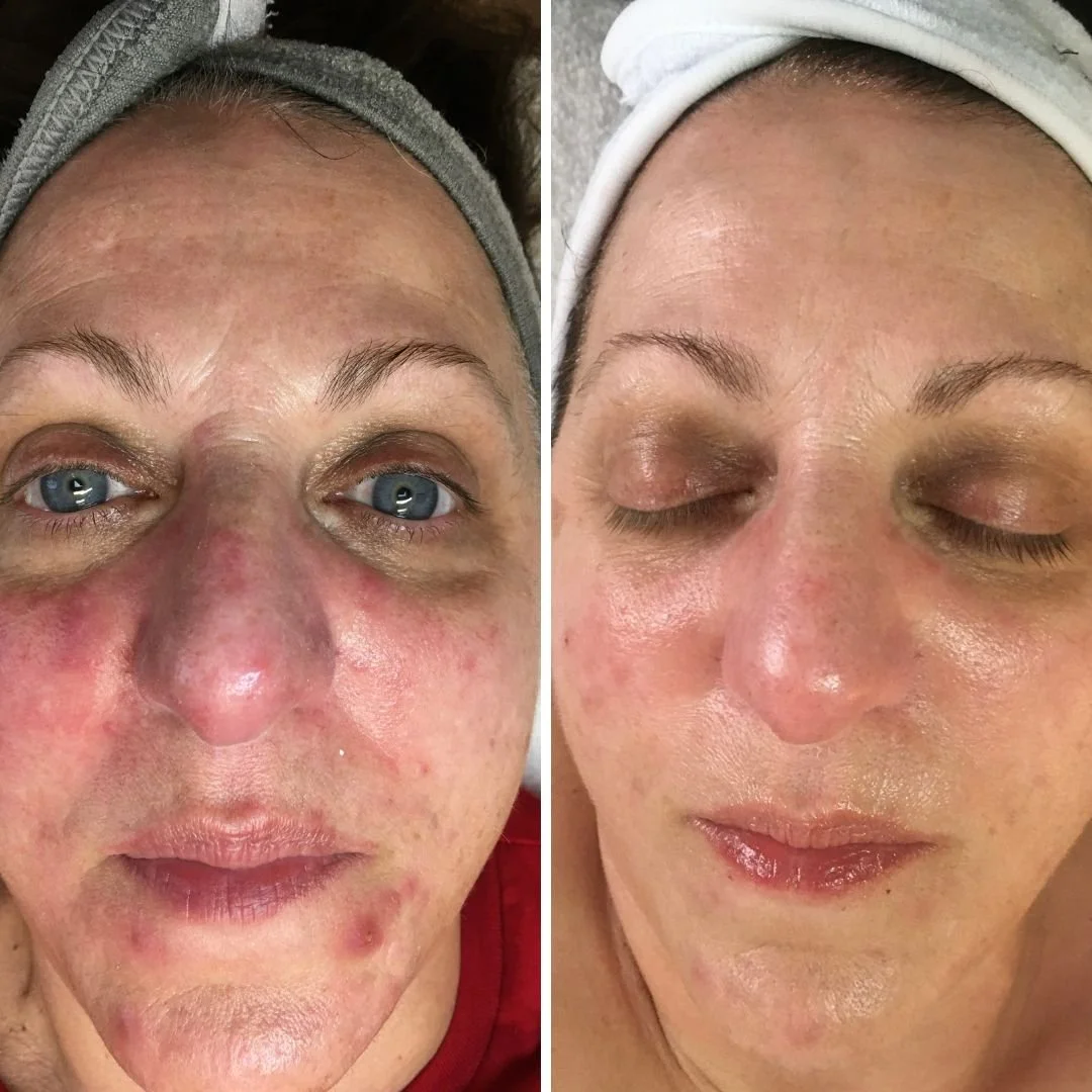 Before and after cryo toning.jpg