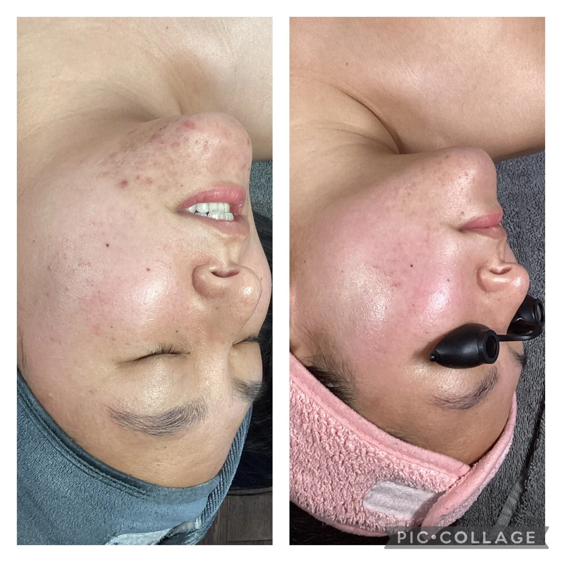 AEE Acne Client Results - Before and After 12.jpeg