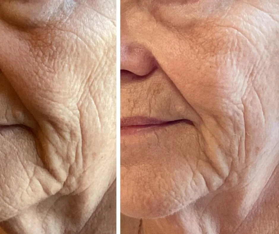Female with noticeable fine lines and wrinkles shows improvement after Jet Plasma treatment