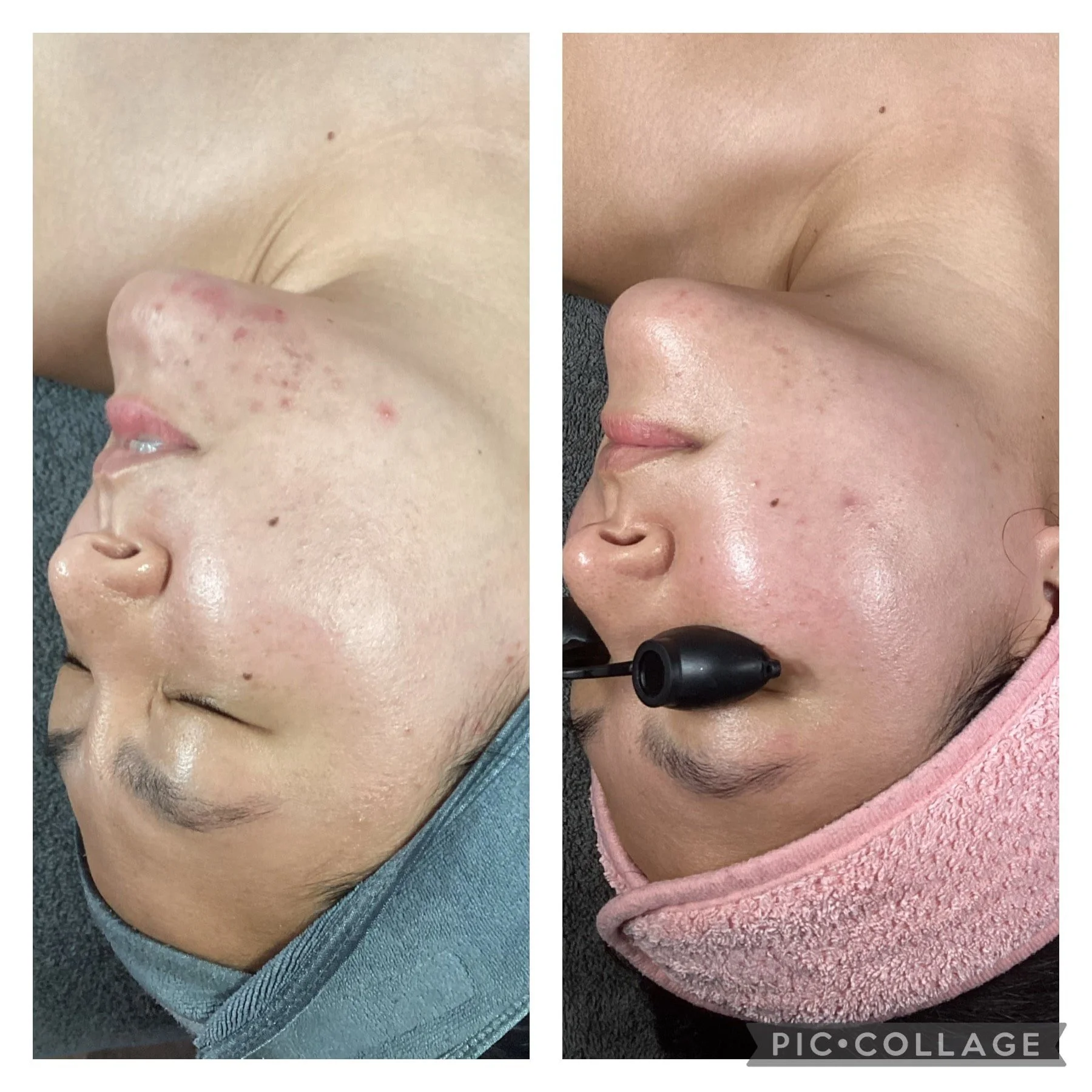 AEE Acne Client Results - Before and After 3.jpeg