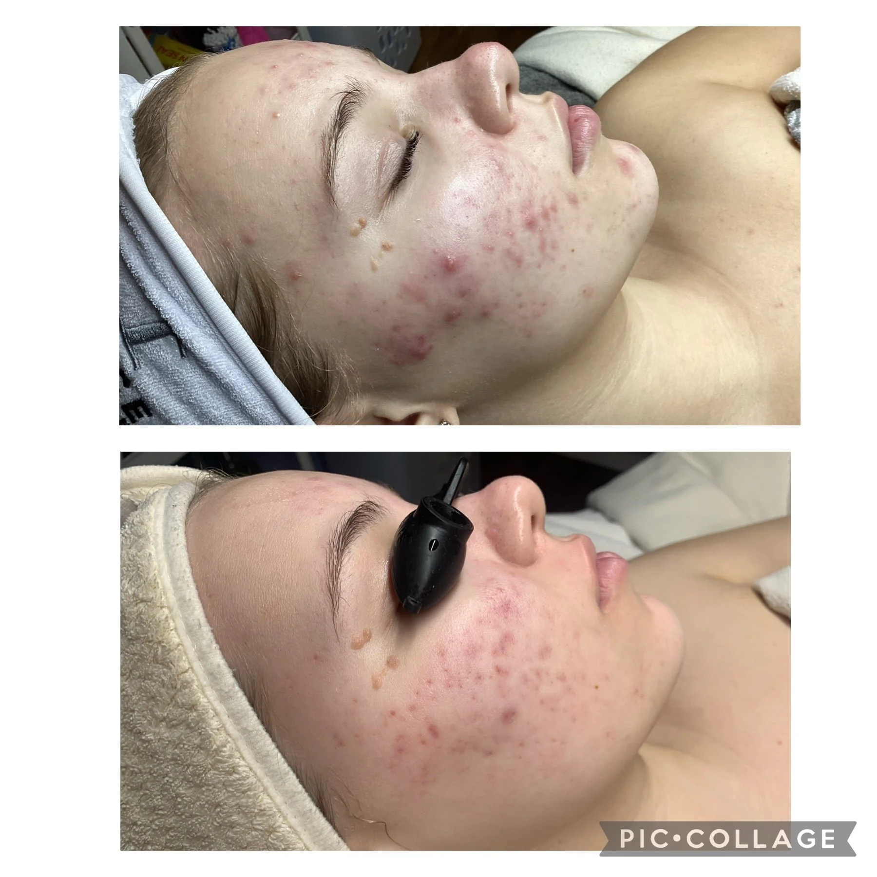 AEE Acne Client Results - Before and After 11.jpeg