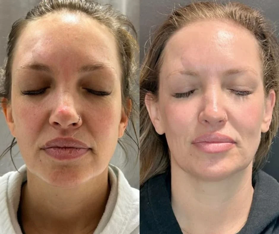 Side-by-side comparison of two women with closed eyes, showing their skin before and after Jet Plasma in Buffalo