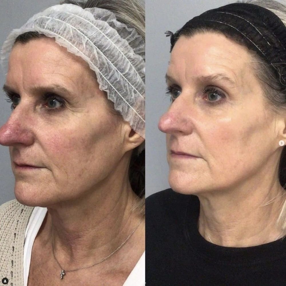 Sculpting facial in Buffalo - Female before and after results