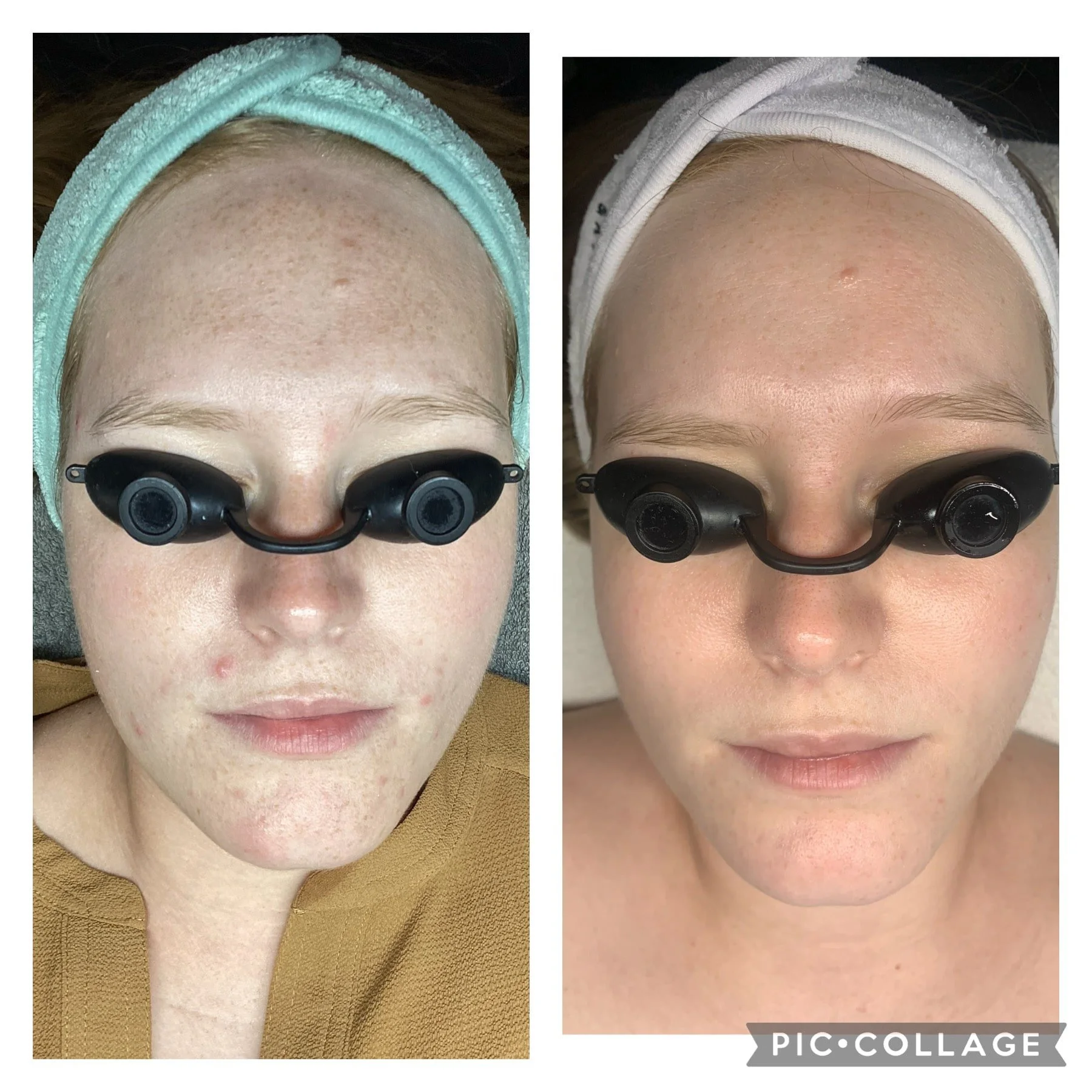 AEE Acne Client Results - Before and After 4.jpeg