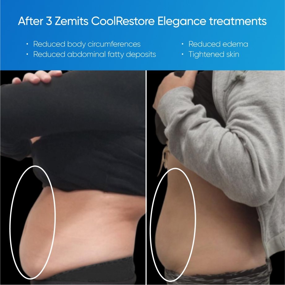Before and after side view results for Cryo Slimming on the stomach