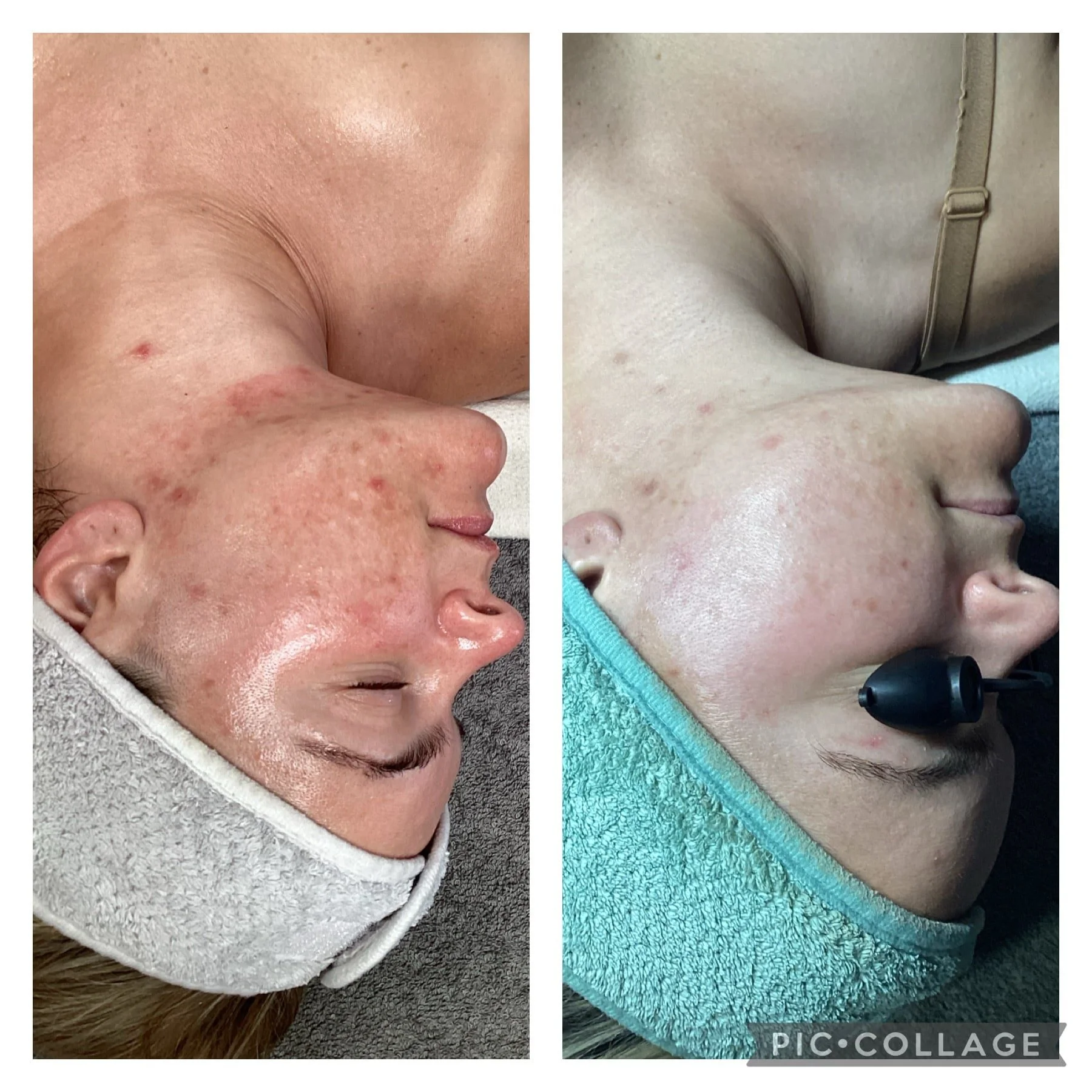 AEE Acne Client Results - Before and After 7.jpeg