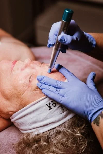 Rezenerate NanoFacial in progress