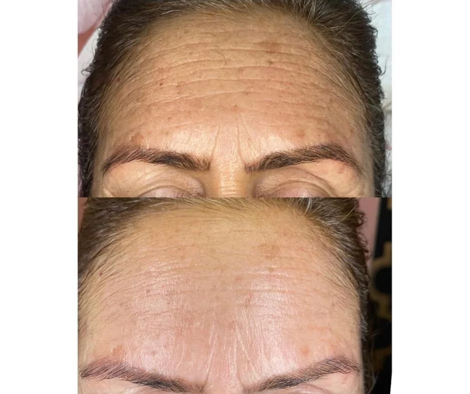 Close-up of a woman's forehead showing before and after skin treatment, with visible reduction in wrinkles and improved smoothness.