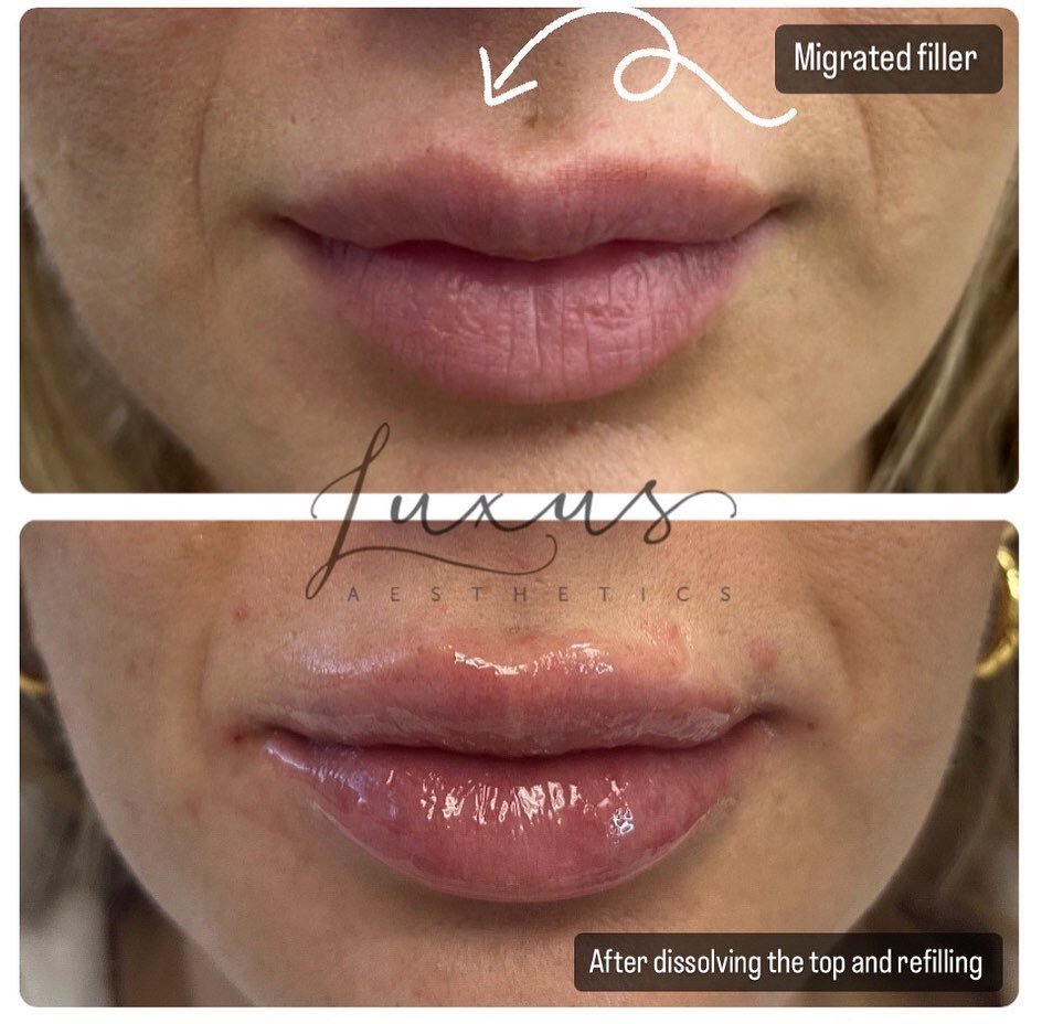 Guess what?! Filler can migrate sometimes due to age, misplacement, overfilling or incorrect type of filler. We can dissolve old filler with Hylenex and then refill for more optimal results! 

The first picture is the first time I saw this lovely cli