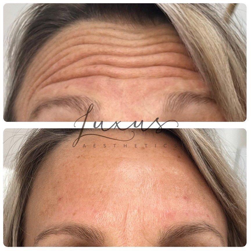 Dysport for the win. We treated glabella (between the eyes) and the forehead. The pictures are two weeks apart post Dysport treatment. Effects will continue to improve with time and consistent treatments. Lines will continue to soften if the muscles 