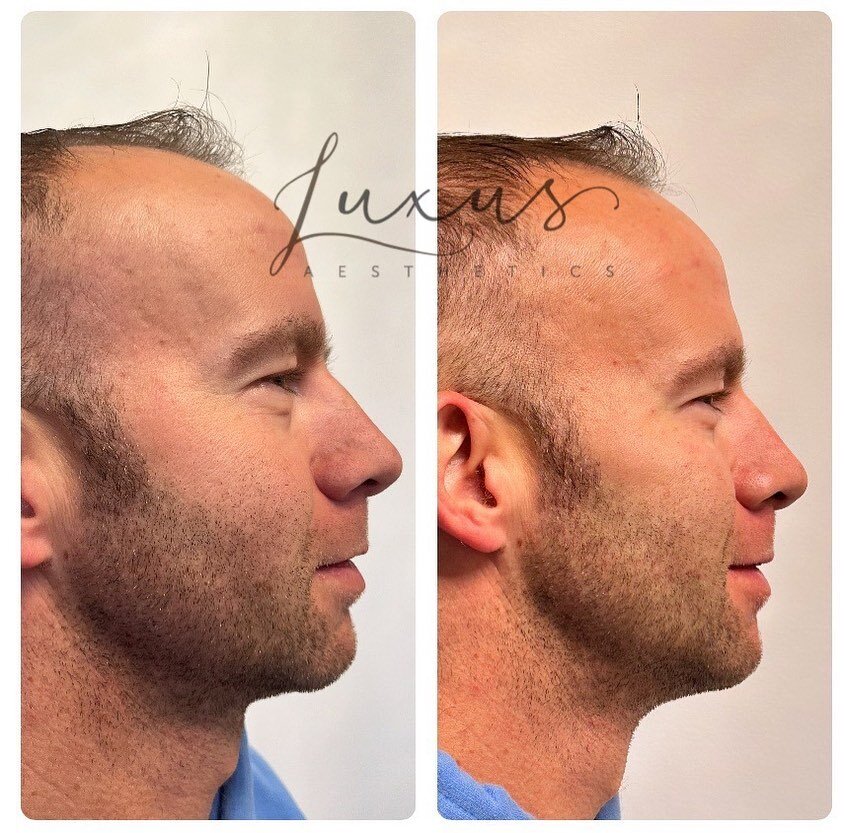 Mid face (cheek) rejuvenation for this guy. We did not treat jawline although it appears more defined and youthful. This is simply the lifting effect from treating the midface with filler. Four syringes total in one sitting. This treatment was perfor