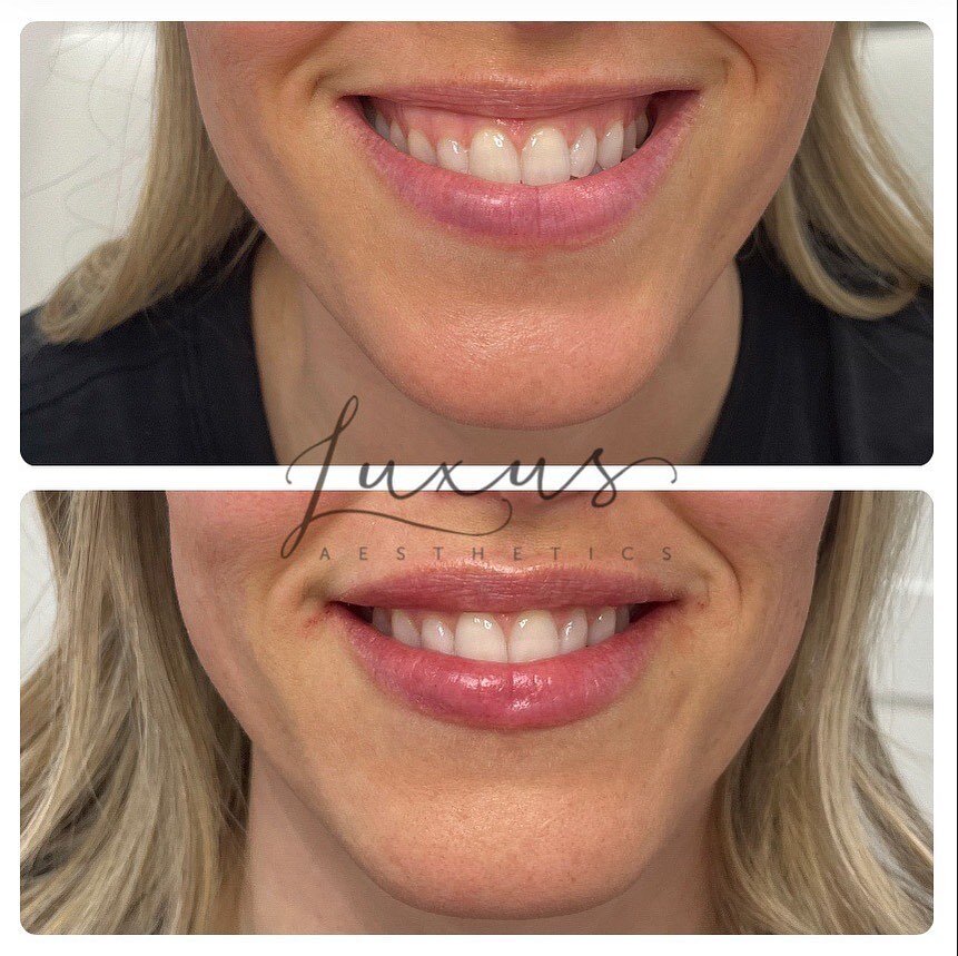 Gummy smile correction with half of a syringe of lip filler. We can combine Botox/Dysport and filler in this area for optimal results. 
.
.
.
#gummysmile #gummysmilecorrection #lipfiller #lipfillerbeforeandafter #lipflip #nurseinjector #nursepractiti
