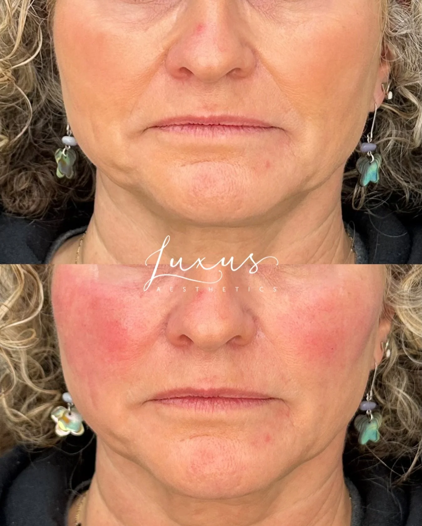 Before &amp; after cheek filler with Nurse Injector Emily Nordstrom 💉👏🏻✨ 

This client had her mid-face treated with cheek filler to improve symmetry, soften nasal labial folds, and to reduce jowling in the lower face. The after photo was taken im