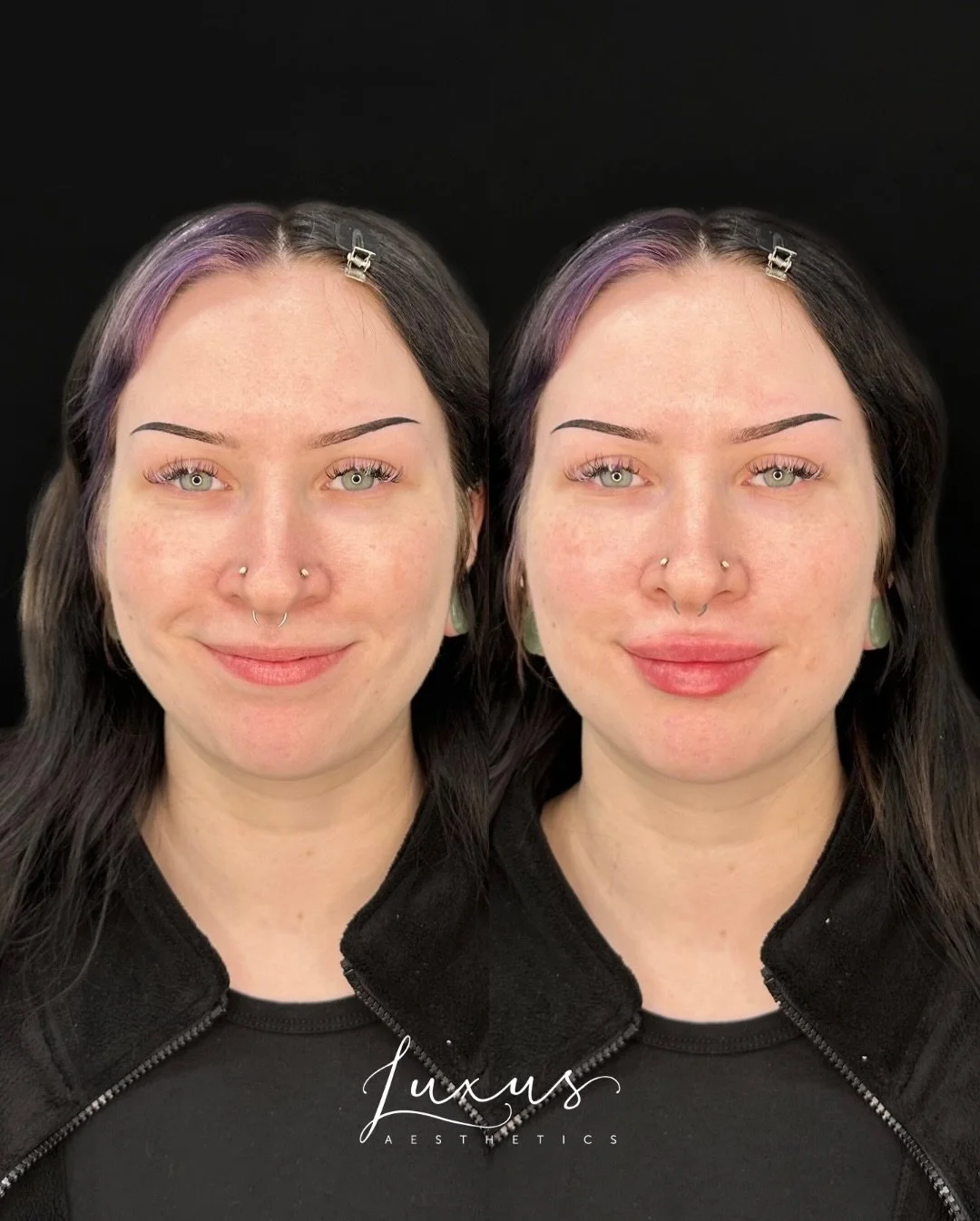 Beautiful results for this first-time lip filler client who was treated with 1 syringe by Holly Hamm, RN! 💫💉

&mdash;&mdash;

Make an appointment at our Happy Valley, OR office by calling us at 971-349-0942 or going online to www.luxusaesthetics.co