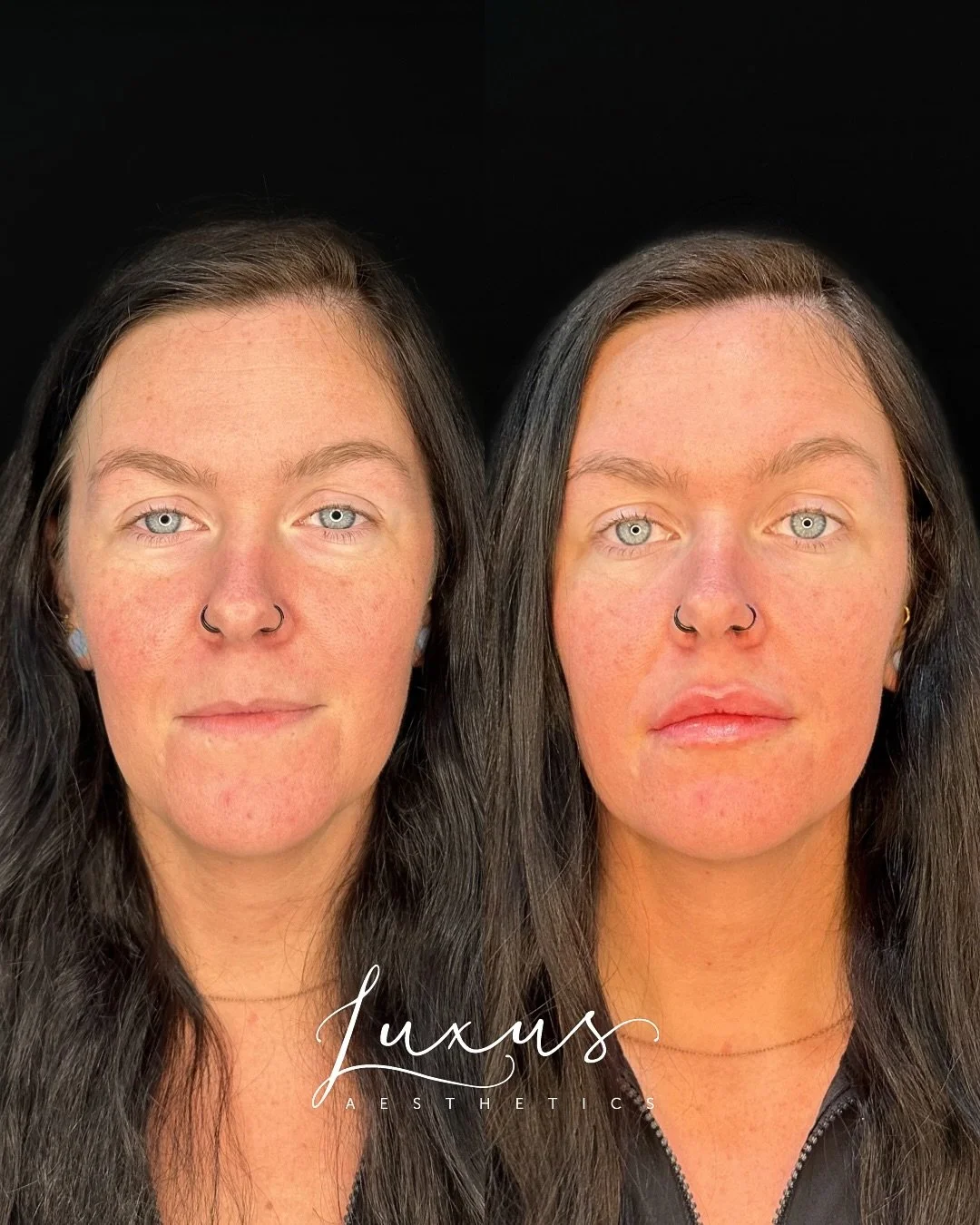 Beautiful lip filler results by Registered Nurse &amp; Injector Holly Hamm at Luxus Aesthetics 💋💉✨

This client received 1 full syringe of Juvederm Ultra lip filler and is pictured immediately before &amp; after treatment. Swelling immediately afte