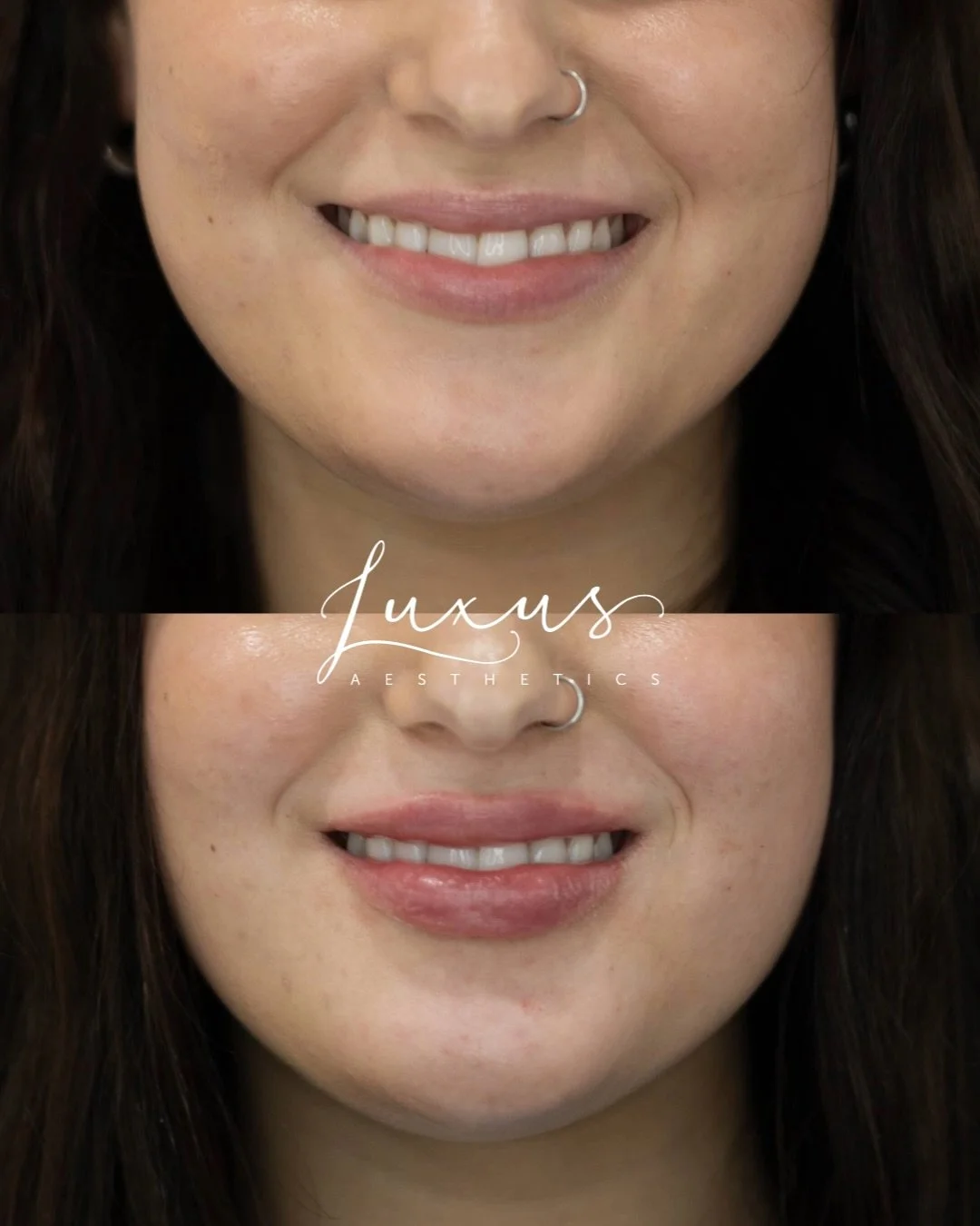 Before &amp; after a half syringe of lip filler with Registered Nurse and Injector Holly Hamm 💉💋 

This client has received 2 full syringes of Juvederm Ultra lip filler over the course of 1 year spread across 4 sessions. 

Starting with a small amo