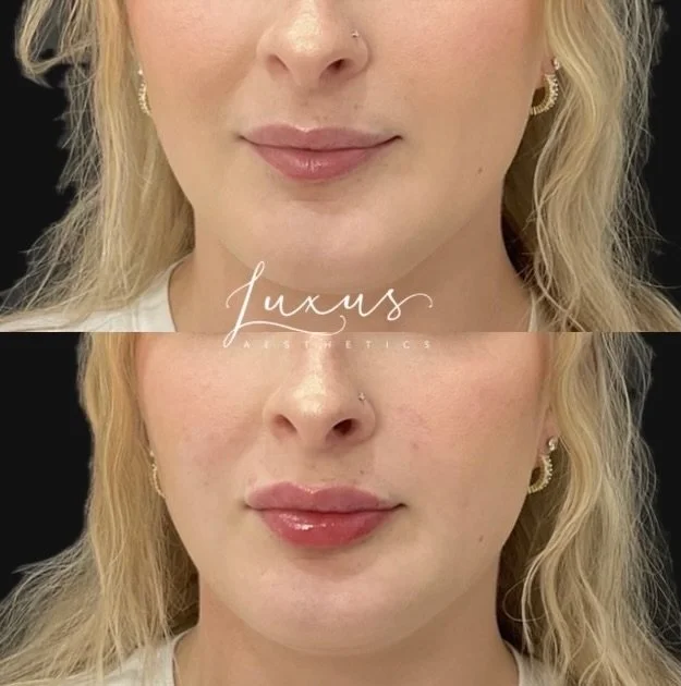 A subtle enhancement can make such a beautiful difference 🤍💉

This client received 1 syringe of lip filler for soft volume, improved symmetry, and a naturally hydrated look. We focused on enhancing her natural shape while keeping the results balanc