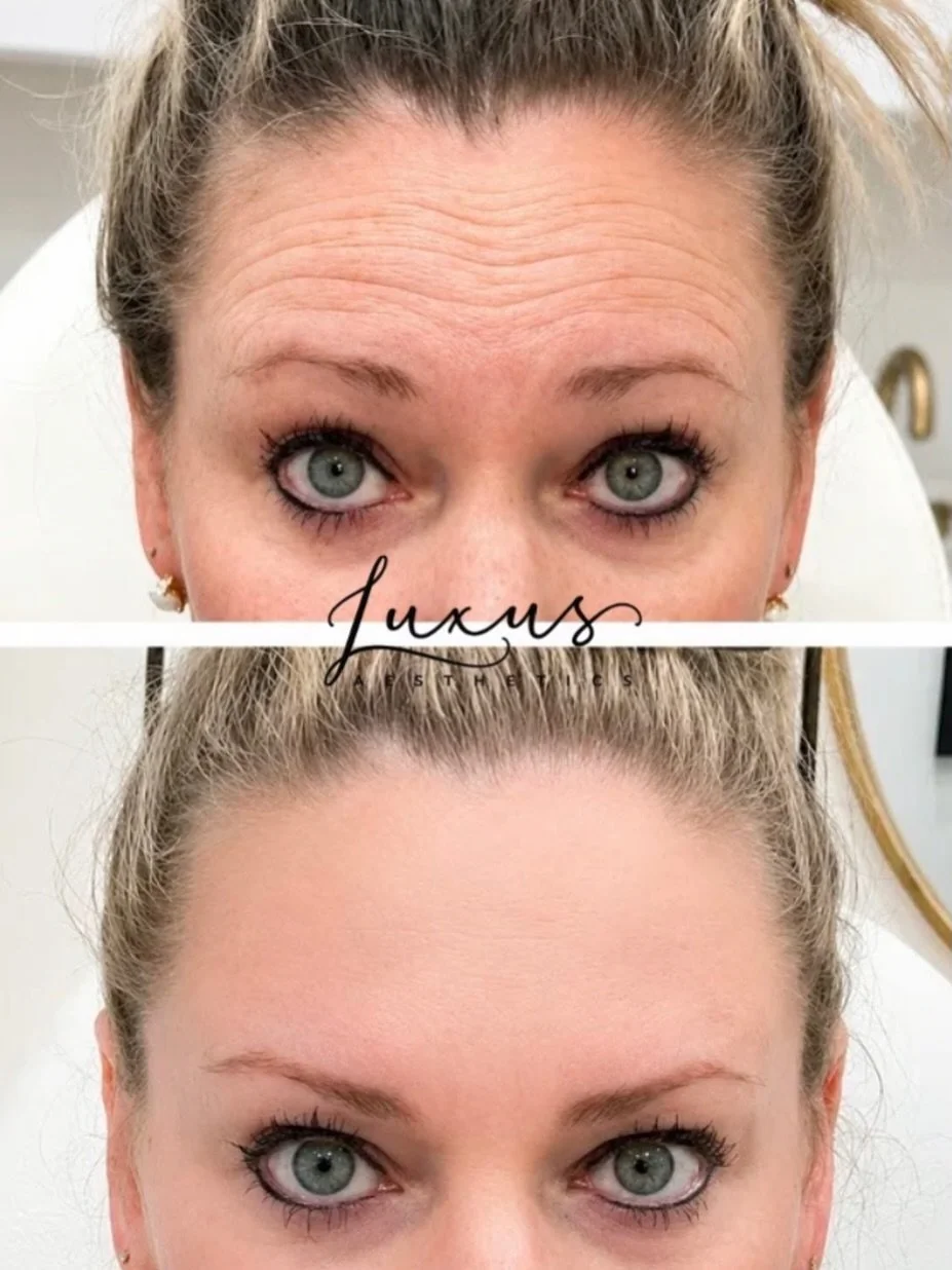 Smooth, refreshed, and naturally you ✨
Forehead lines softened with tox by Sam for a subtle, beautiful result. 💉🤍 

Book an appointment by giving our office a call or by going online! (link in bio)

Happy Valley, OR &bull; 971-349-0942
www.luxusaes
