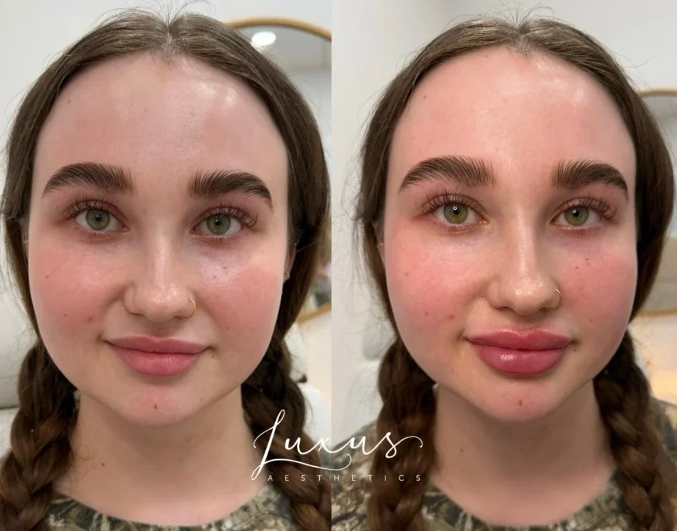 💋This gorgeous lip enhancement was achieved with 1 syringe of lip filler by Laura, creating a fuller, balanced look while keeping everything soft and natural. ✨

Book an appointment by giving our office a call or by going online! (link in bio)

Happ