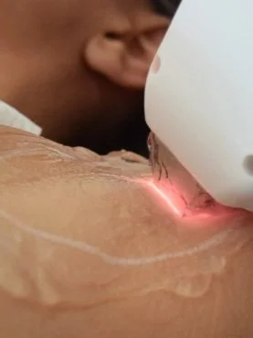 Close-up of a person receiving a laser skin treatment on their neck.