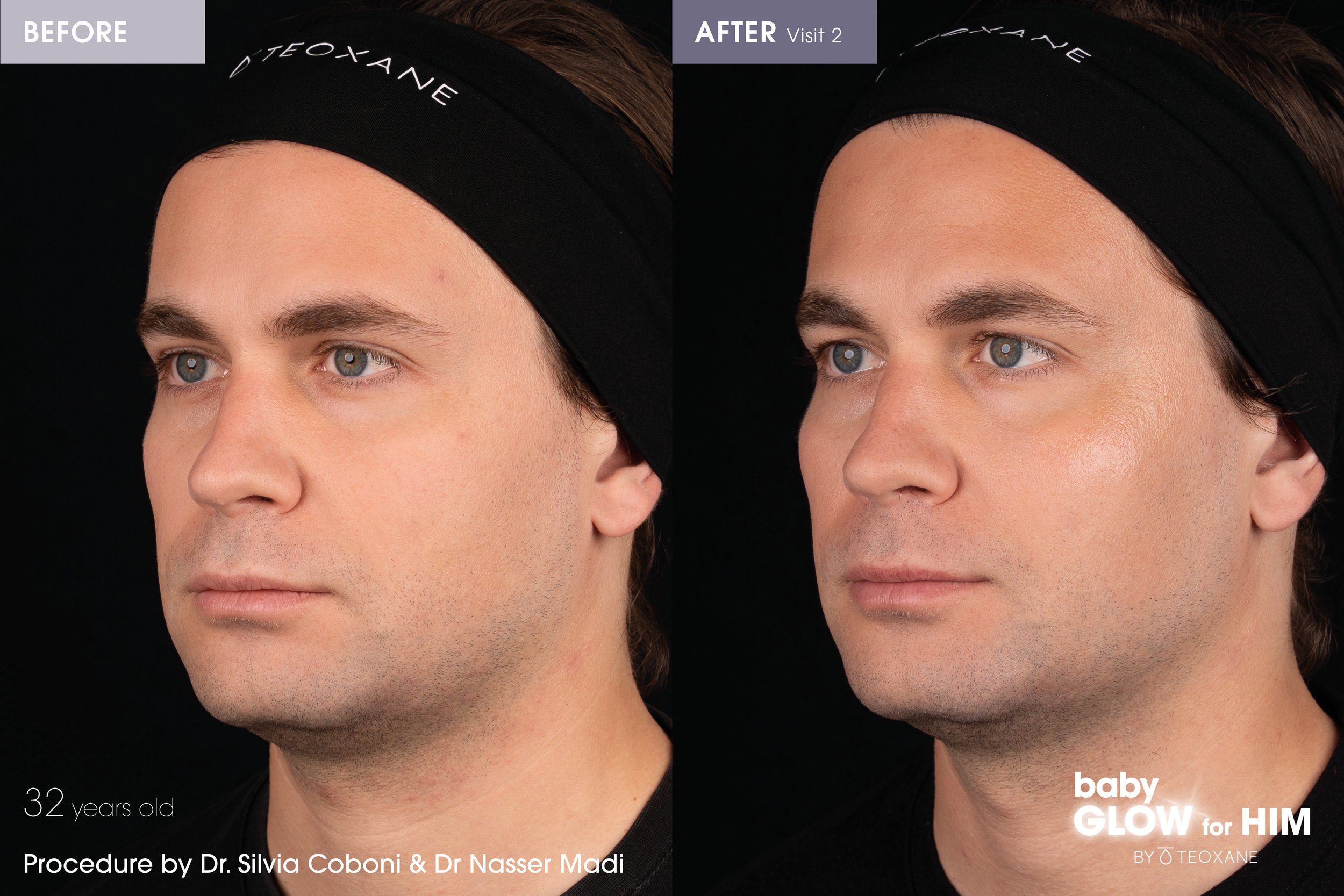 Before and After photo or BabyGlow for HIM skin booster using Teoxane