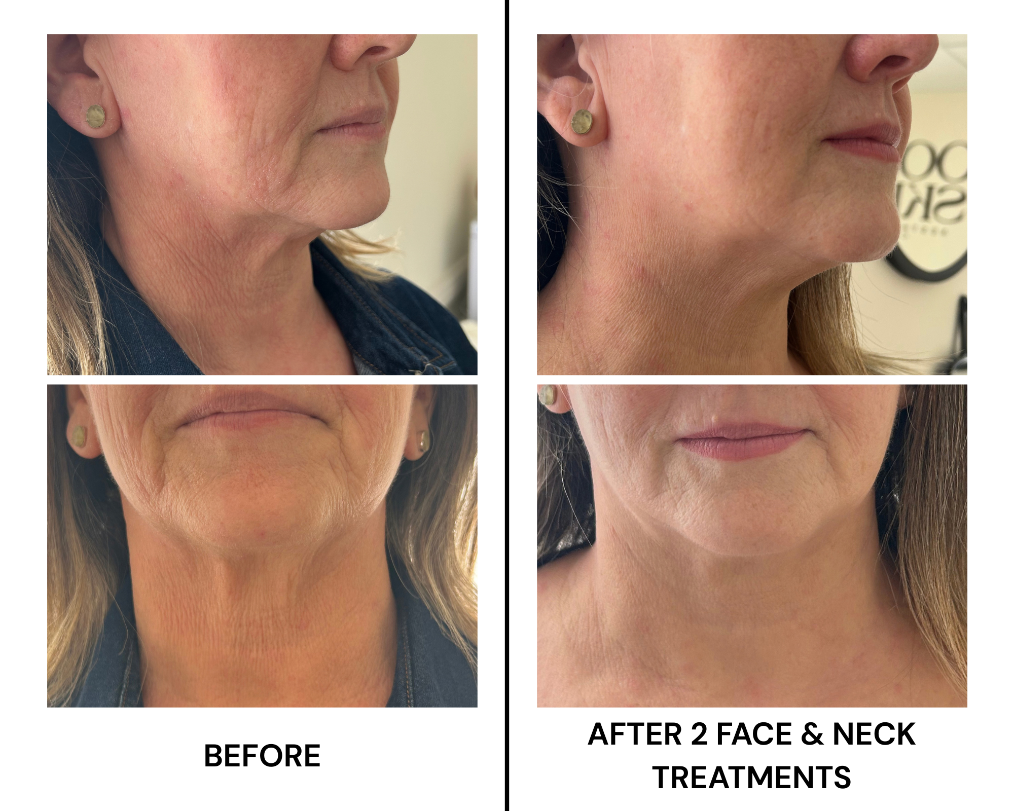 BEFORE AND AFTER OF DERMAFORCE RF MICRONEEDLING OF FACE JOWLS AND JAW