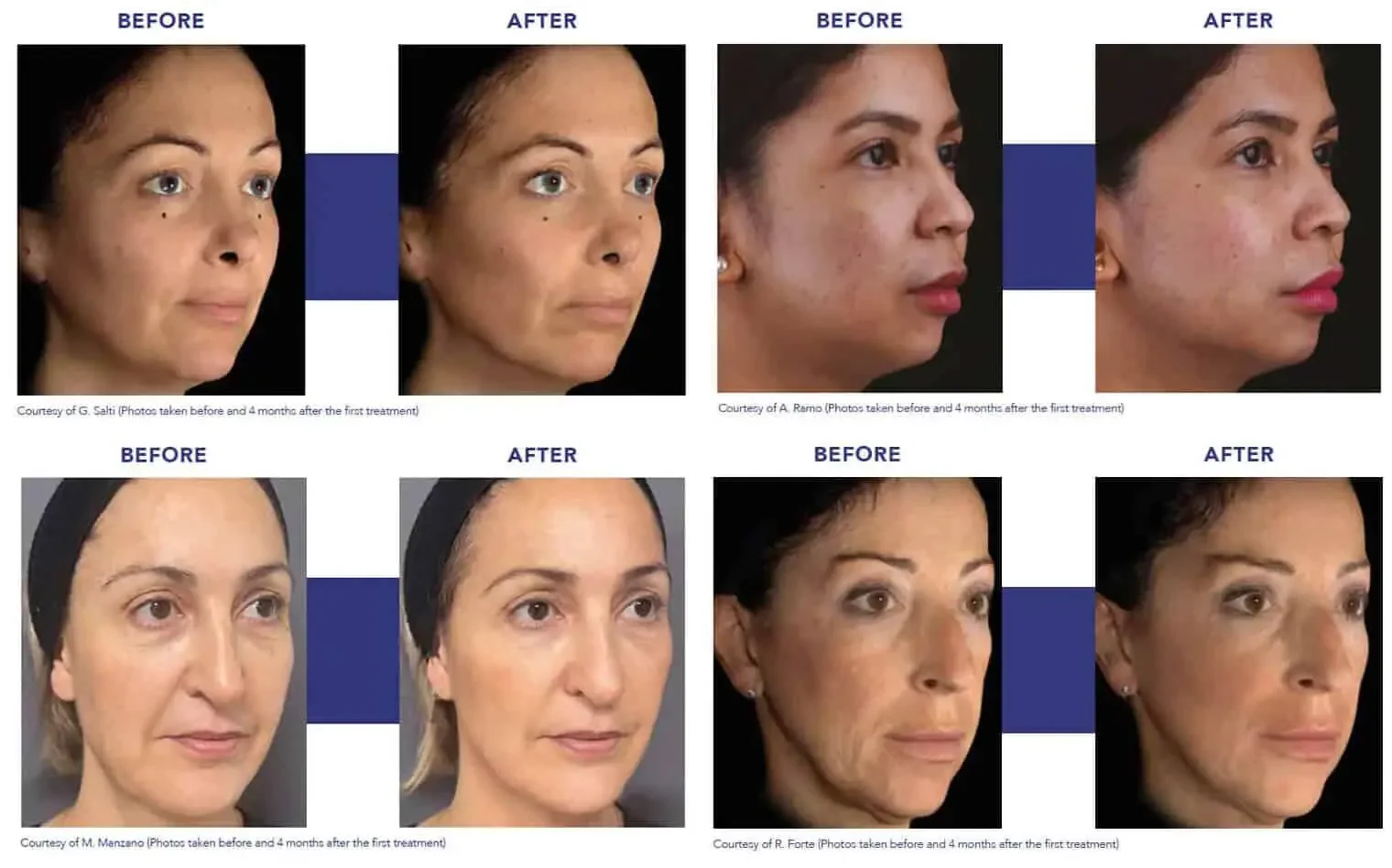 A collage of six side-by-side comparison photos showing before and after results of Profhilo Structura facial treatments on four women, with the words 'BEFORE' and 'AFTER' above each pair.