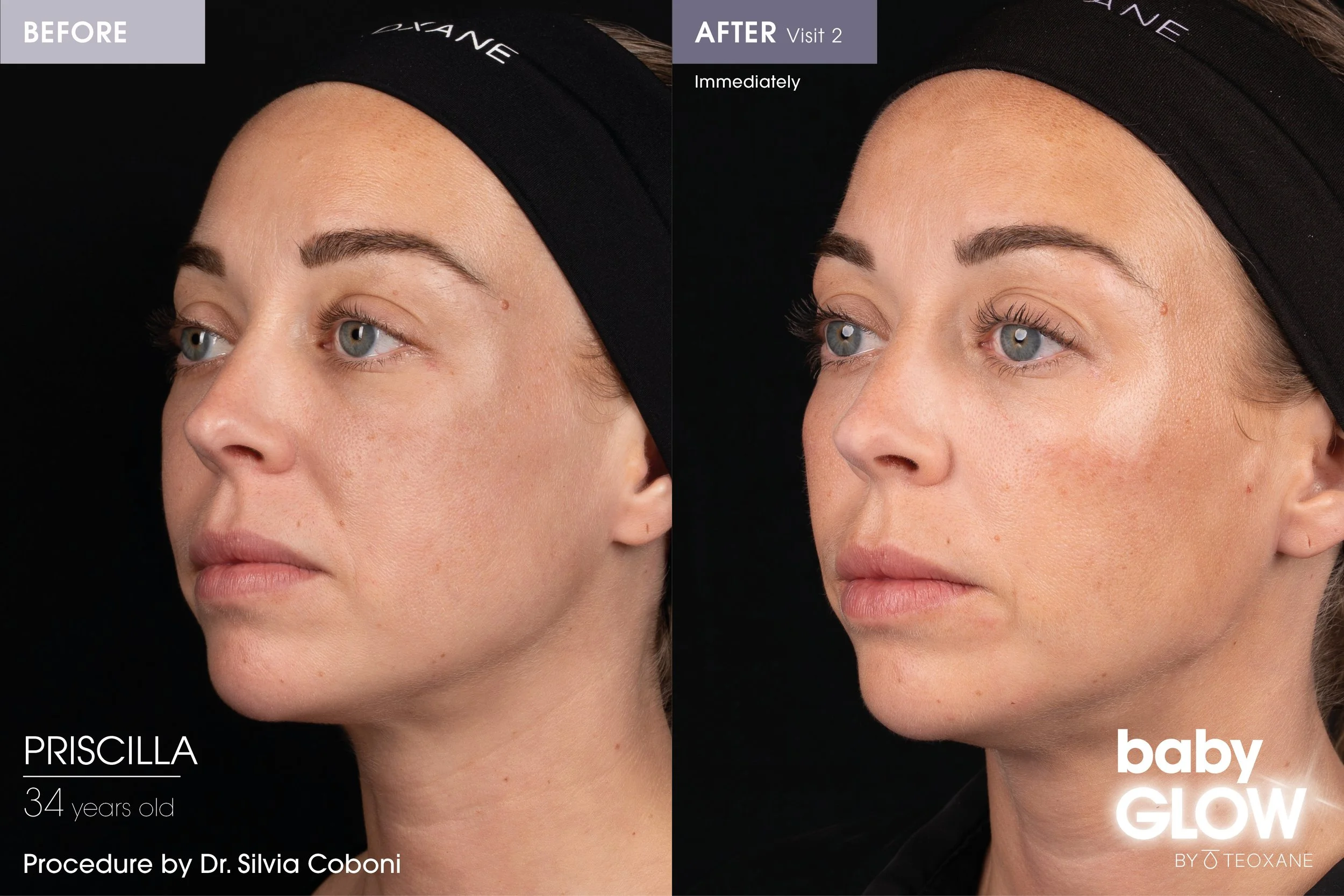 Before and After image of Babyglow results using Teoxane