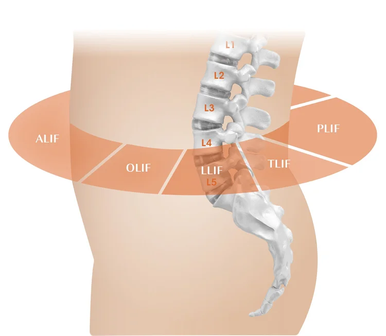 Alif Procedure Incision Lumbar Spine Patient Education — Camber Spine Med Tech