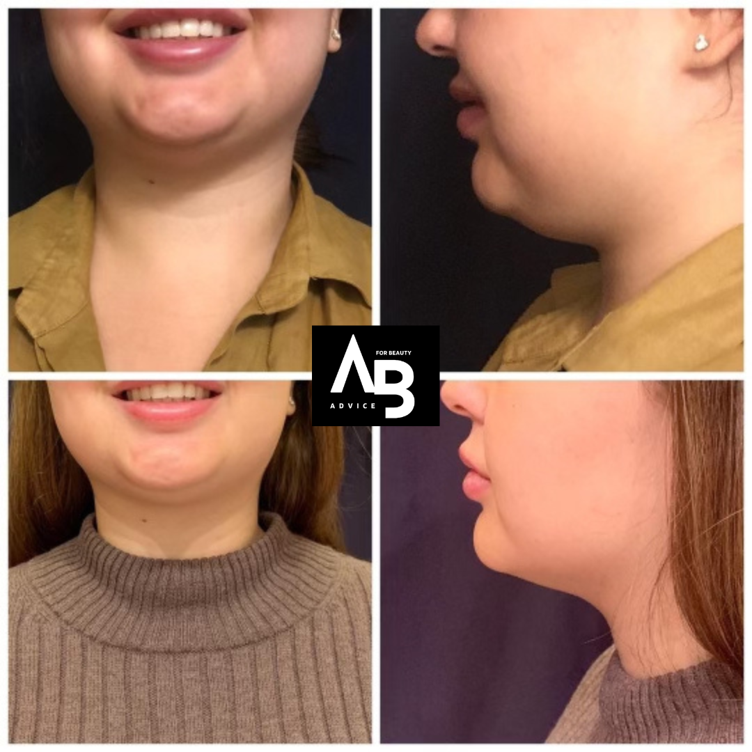 Before & After Kybella