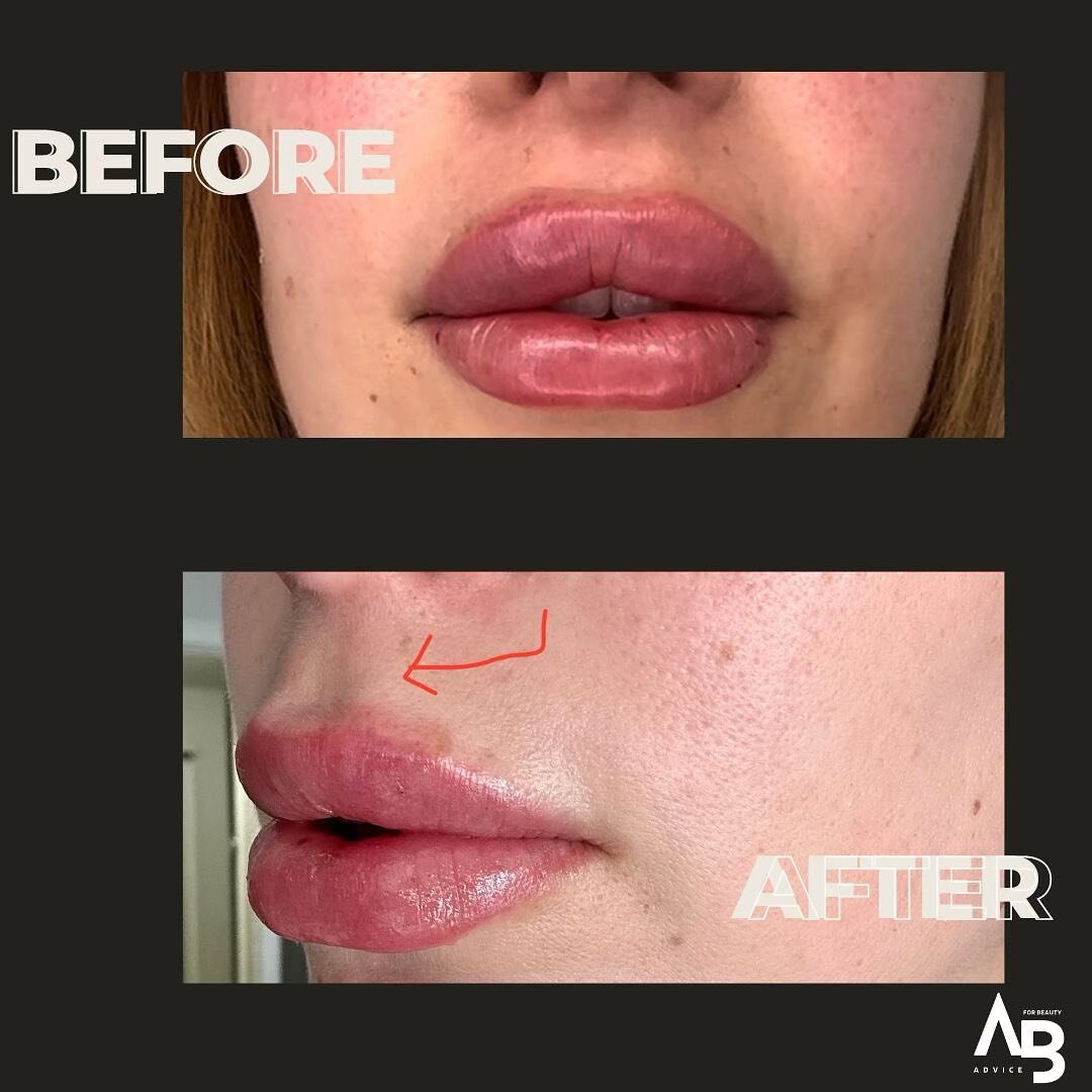 From no volume in the Cupid&rsquo;s Bow area to a brand new defined Cupid&rsquo;s Bow! Treating the Cupid&rsquo;s Bow area requires precision and a solid injecting approach. Adding filler to the philtrum columns can support the Cupid&rsquo;s Bow and 